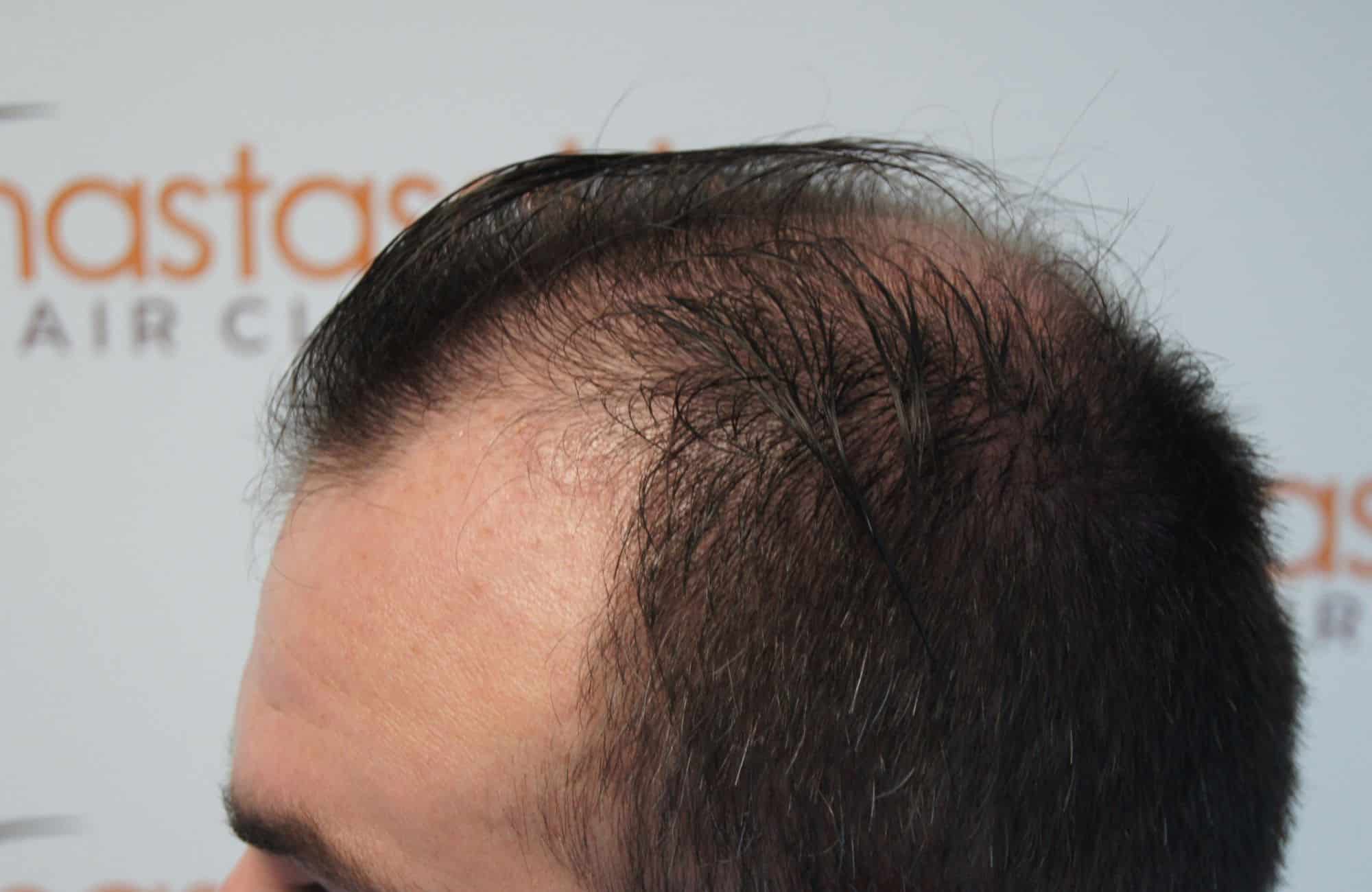 peristatiko prin ti mm stage5 3000fus - 6