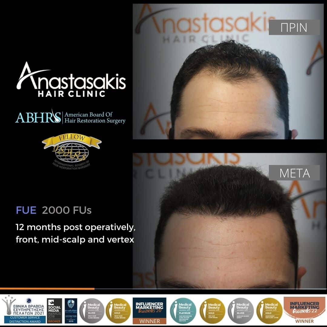 first signs of thinning hair