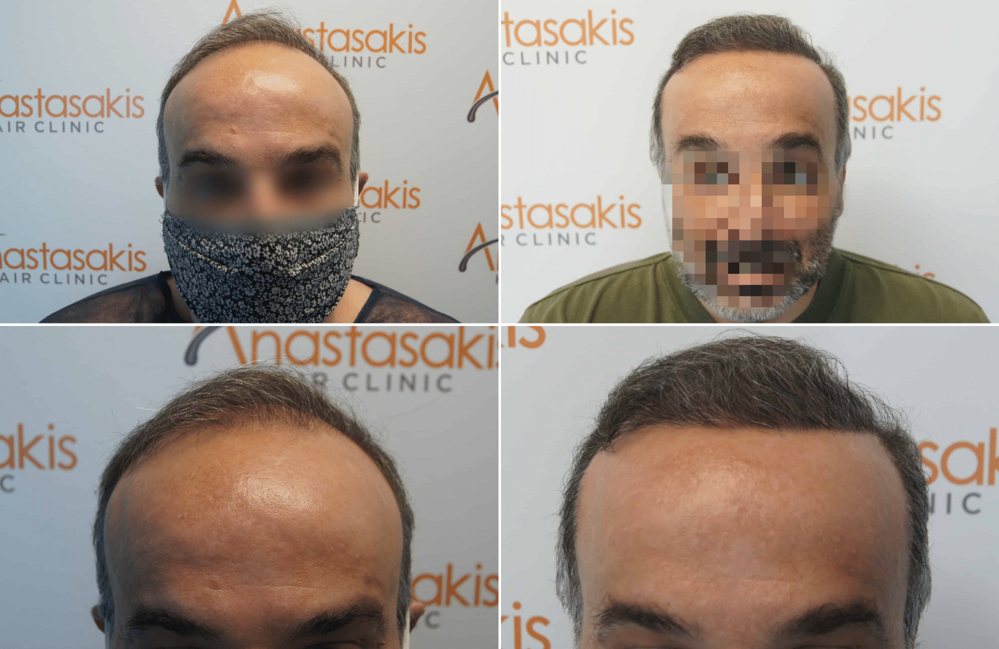https://anastasakishairclinic.com/portfolio/apotelesma-metamosxefsis-mallion-anastasakis-hair-clinic-346/