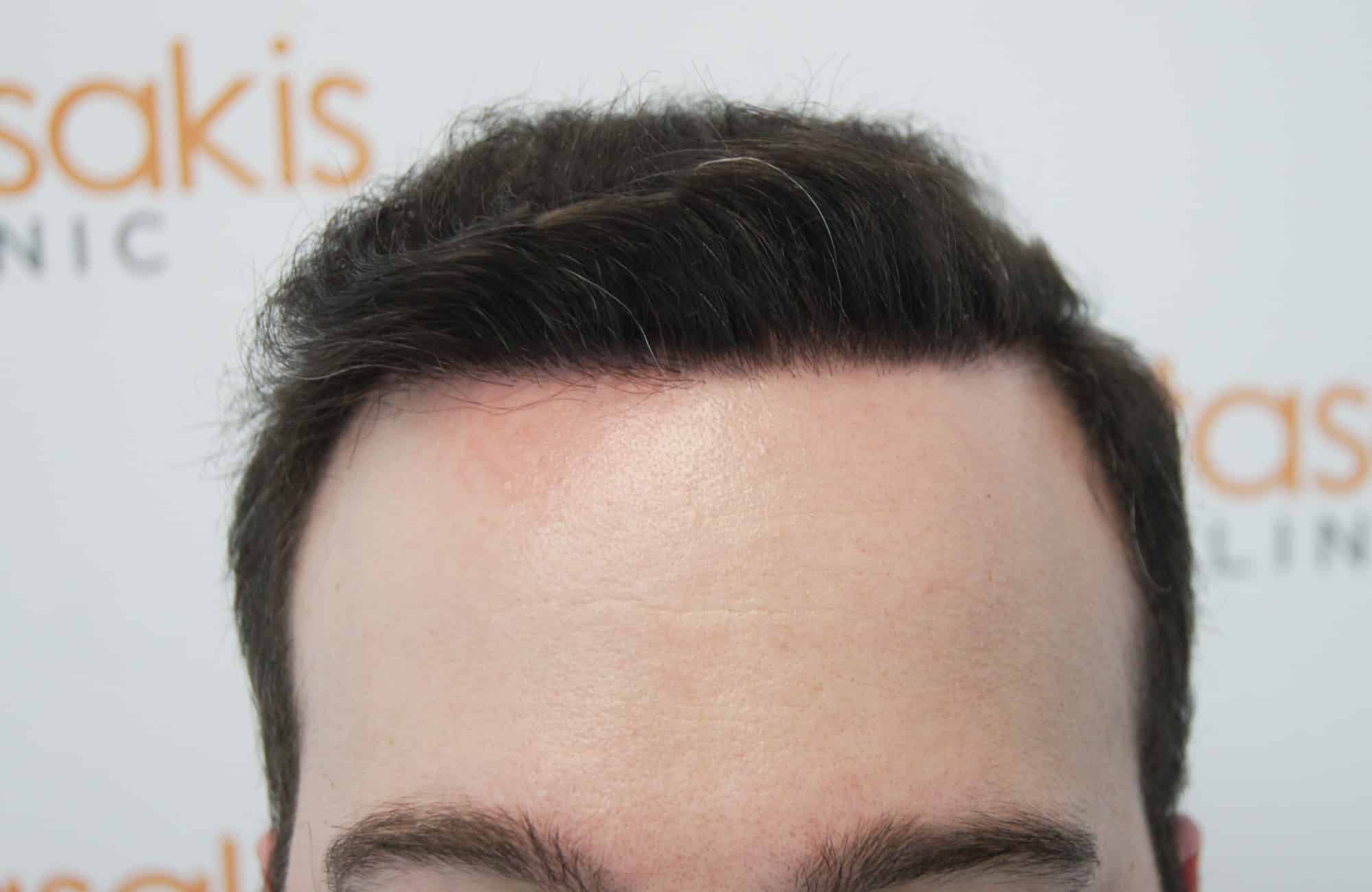 peristatiko metamosxefsis mallion me 3500 fus meta hairline