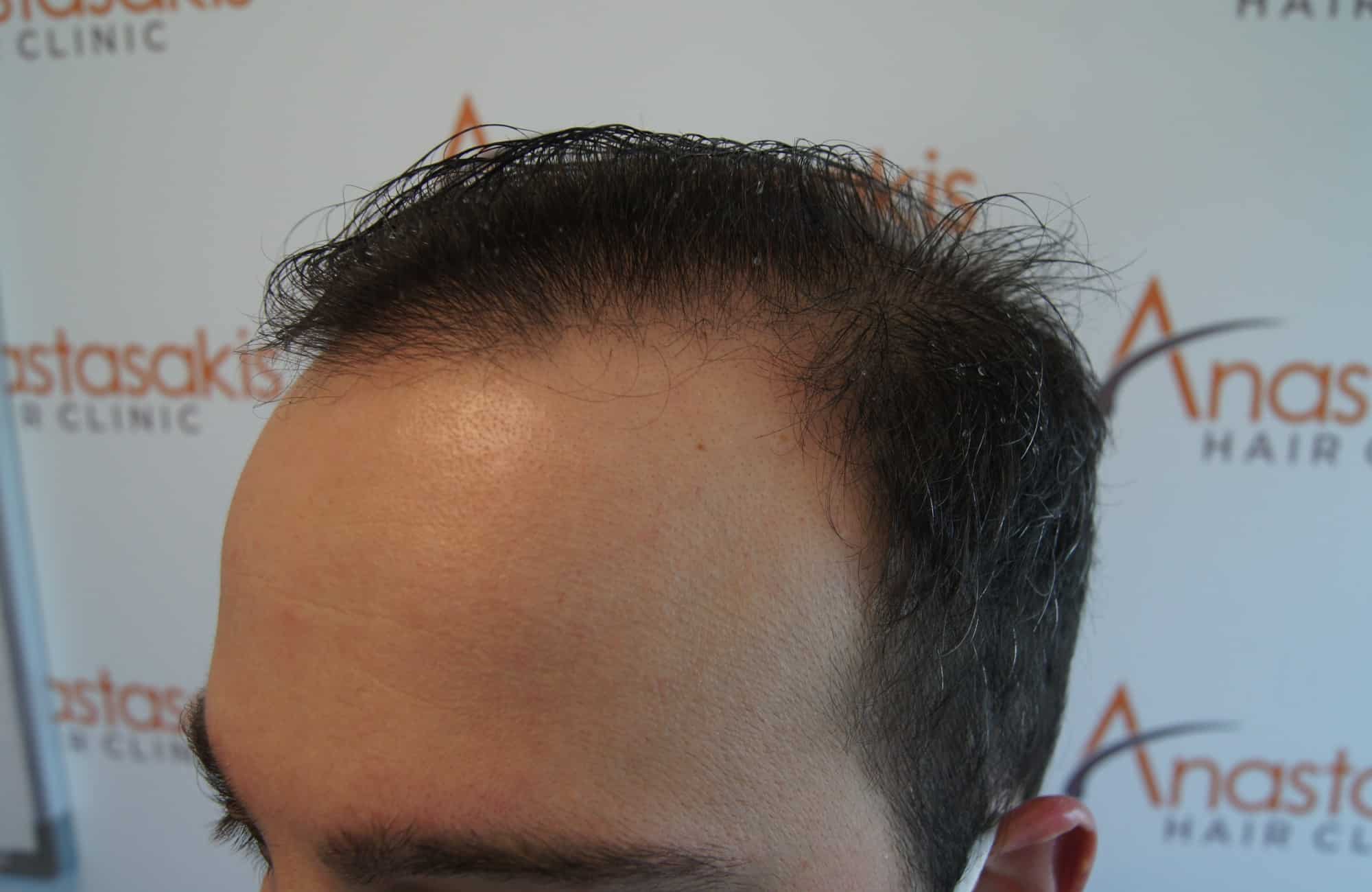 peristatiko metamosxefsis mallion me 3500 fus prin side1
