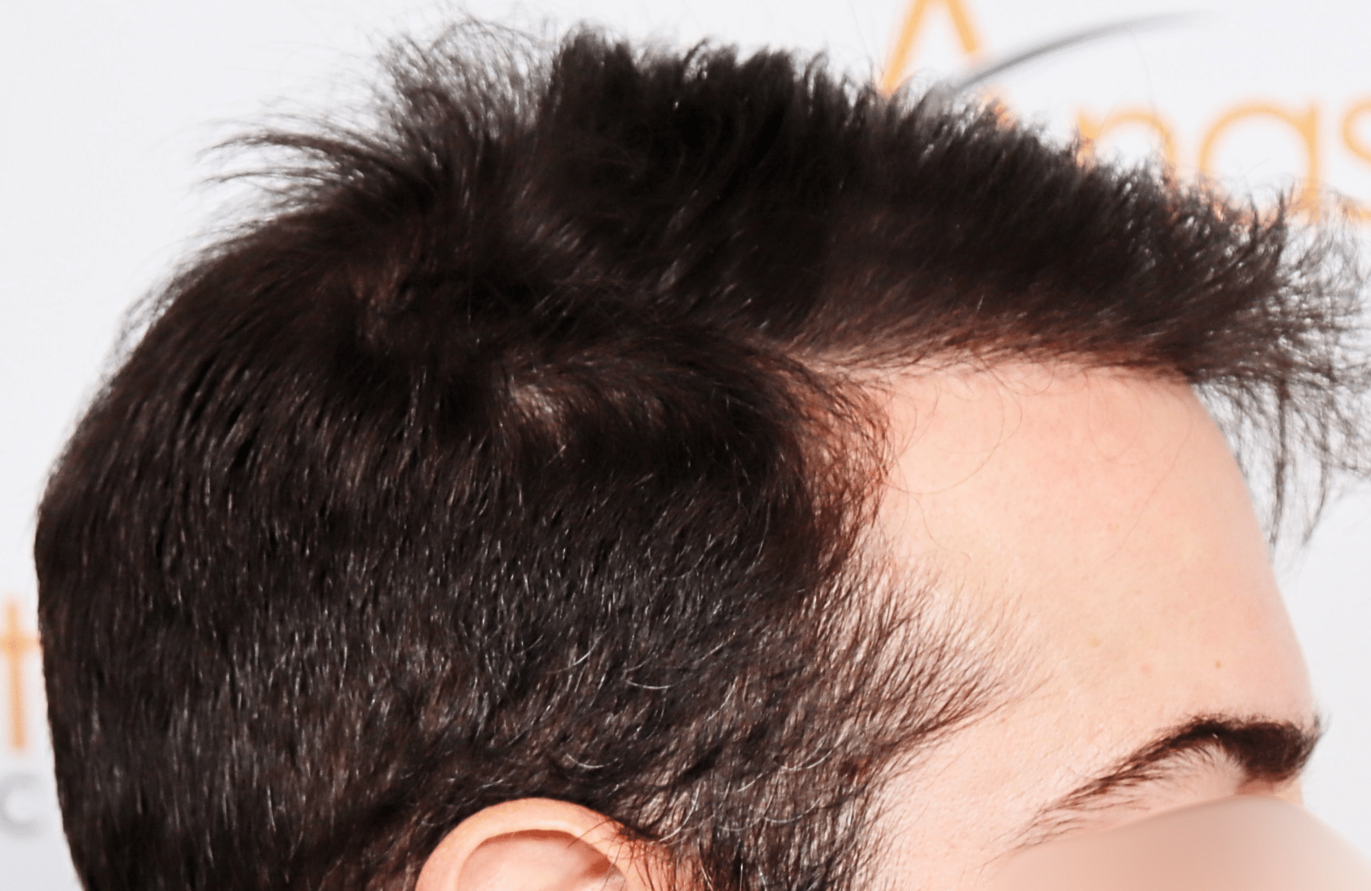 hair transplant result by dr konstantinos anastassakis with 2300 fus side3 after