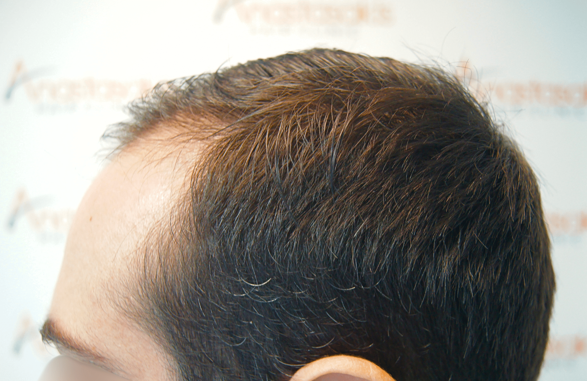 hair transplant result by dr konstantinos anastassakis with 2300 fus side4 before