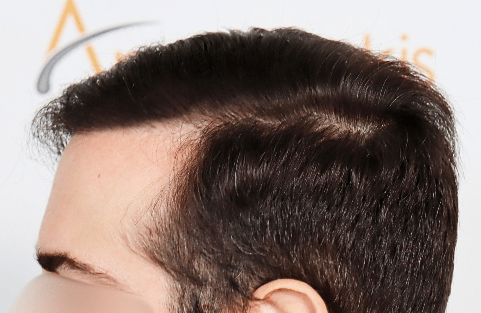 hair transplant result by dr konstantinos anastassakis with 2300 fus side4 after