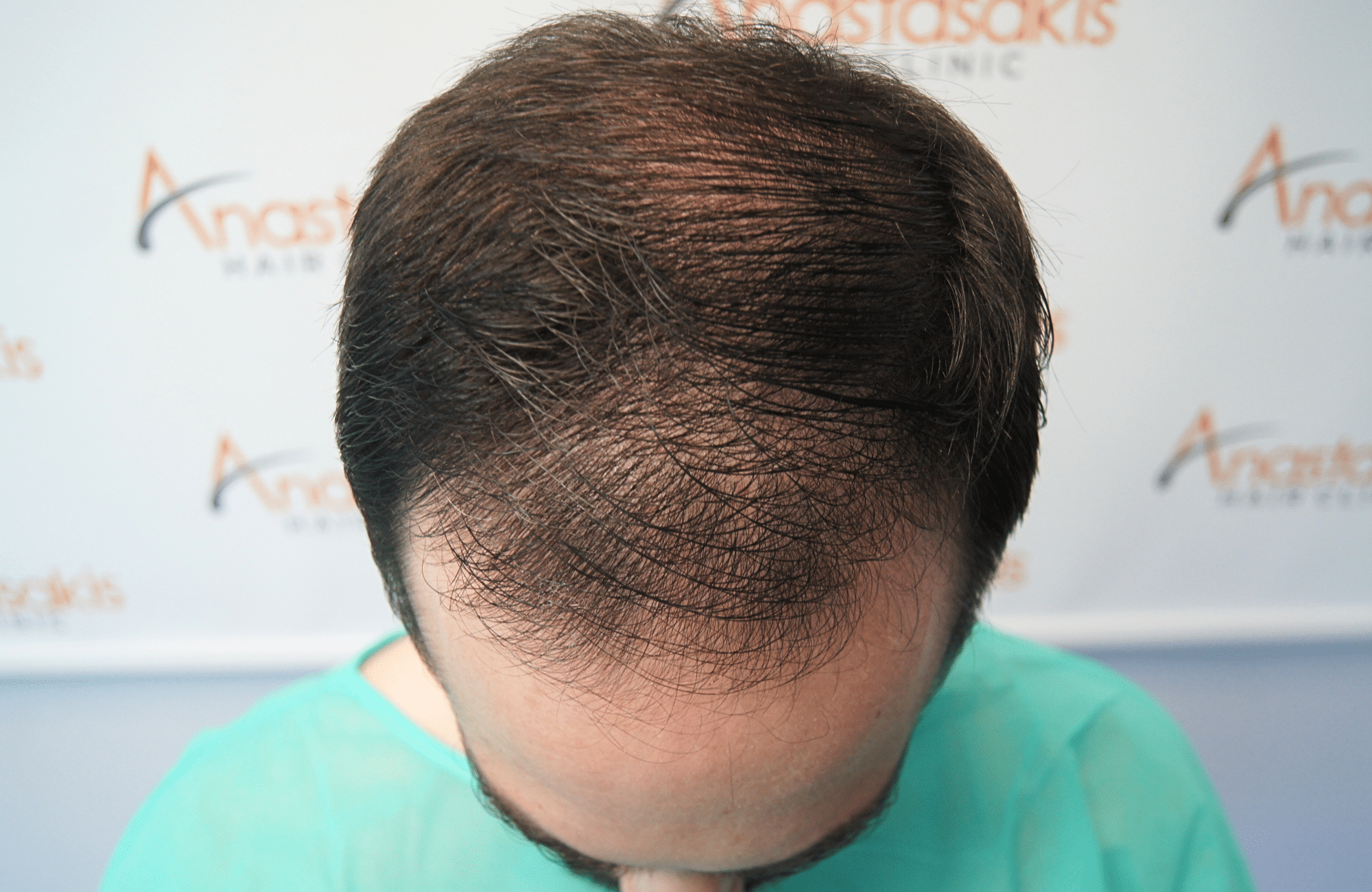 hair transplant result by dr konstantinos anastassakis with 2300 fus frontal before