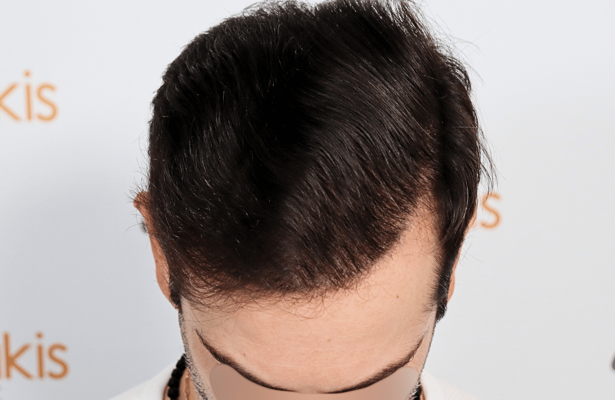 hair transplant result by dr konstantinos anastassakis with 2300 fus frontal after