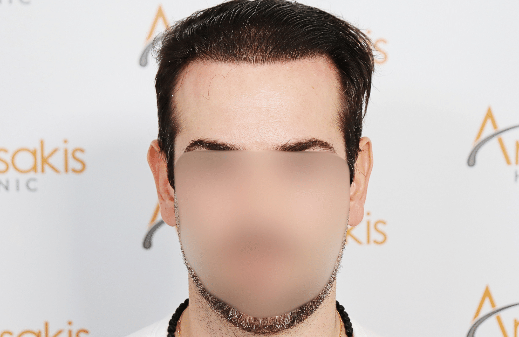 hair transplant result by dr konstantinos anastassakis with 2300 fus fullface after wet hair