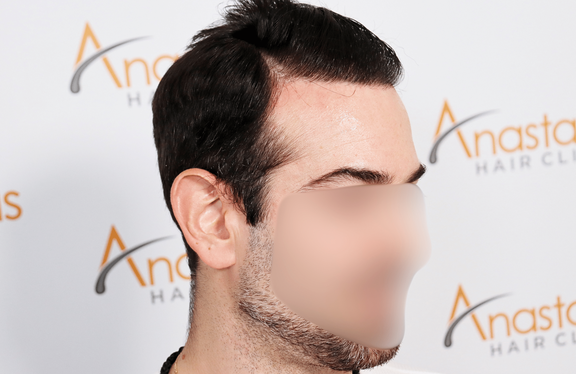 hair transplant result by dr konstantinos anastassakis with 2300 fus side1 after wet hair