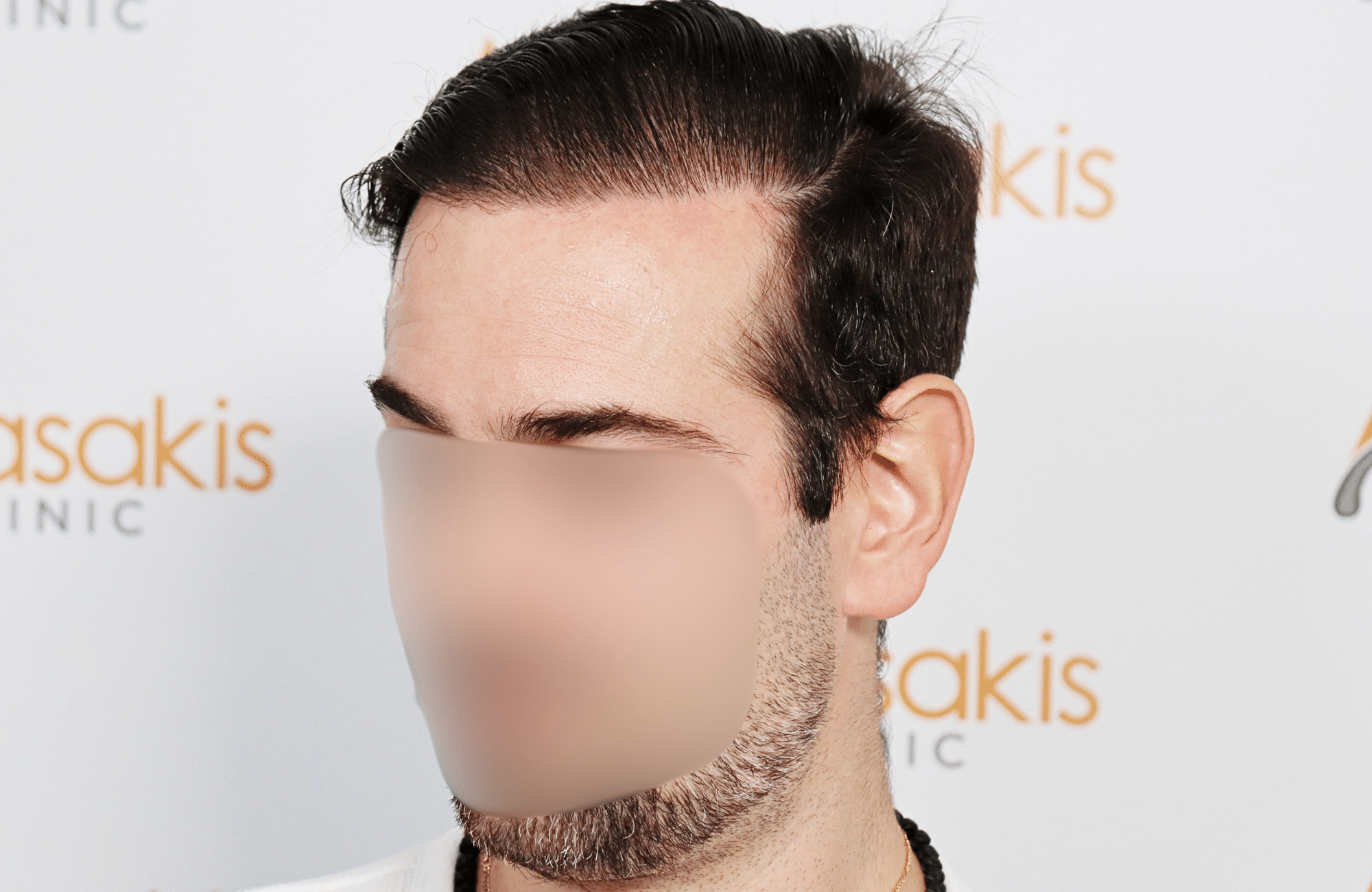 hair transplant result by dr konstantinos anastassakis with 2300 fus side2 after wet hair