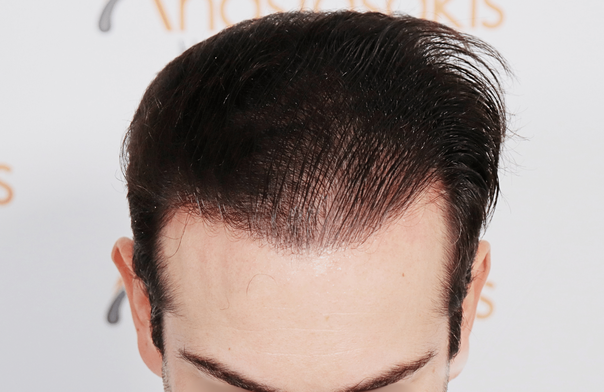 hair transplant result by dr konstantinos anastassakis with 2300 fus frontal after wet hair