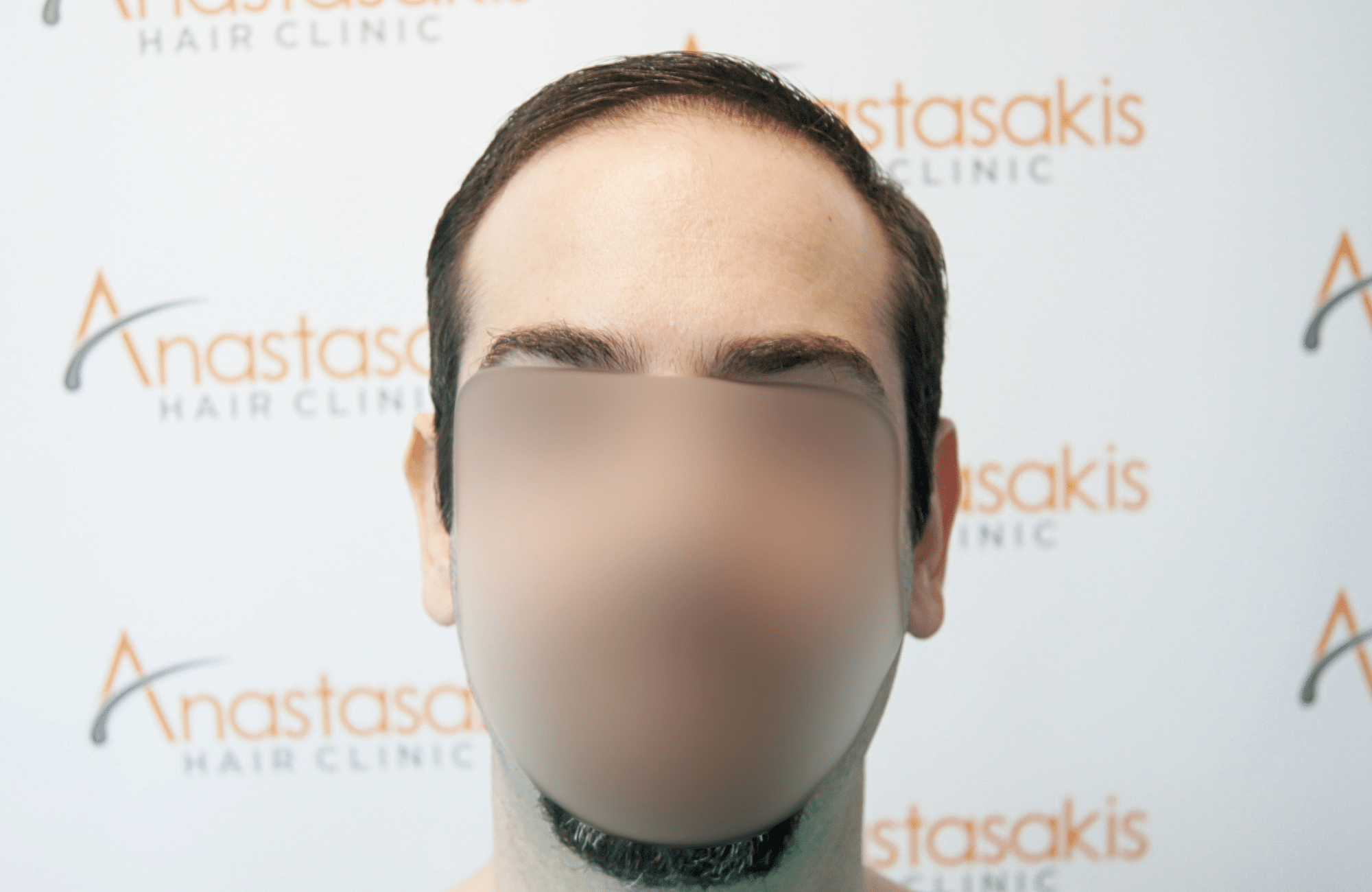 hair transplant result by dr konstantinos anastassakis with 2300 fus fullface before