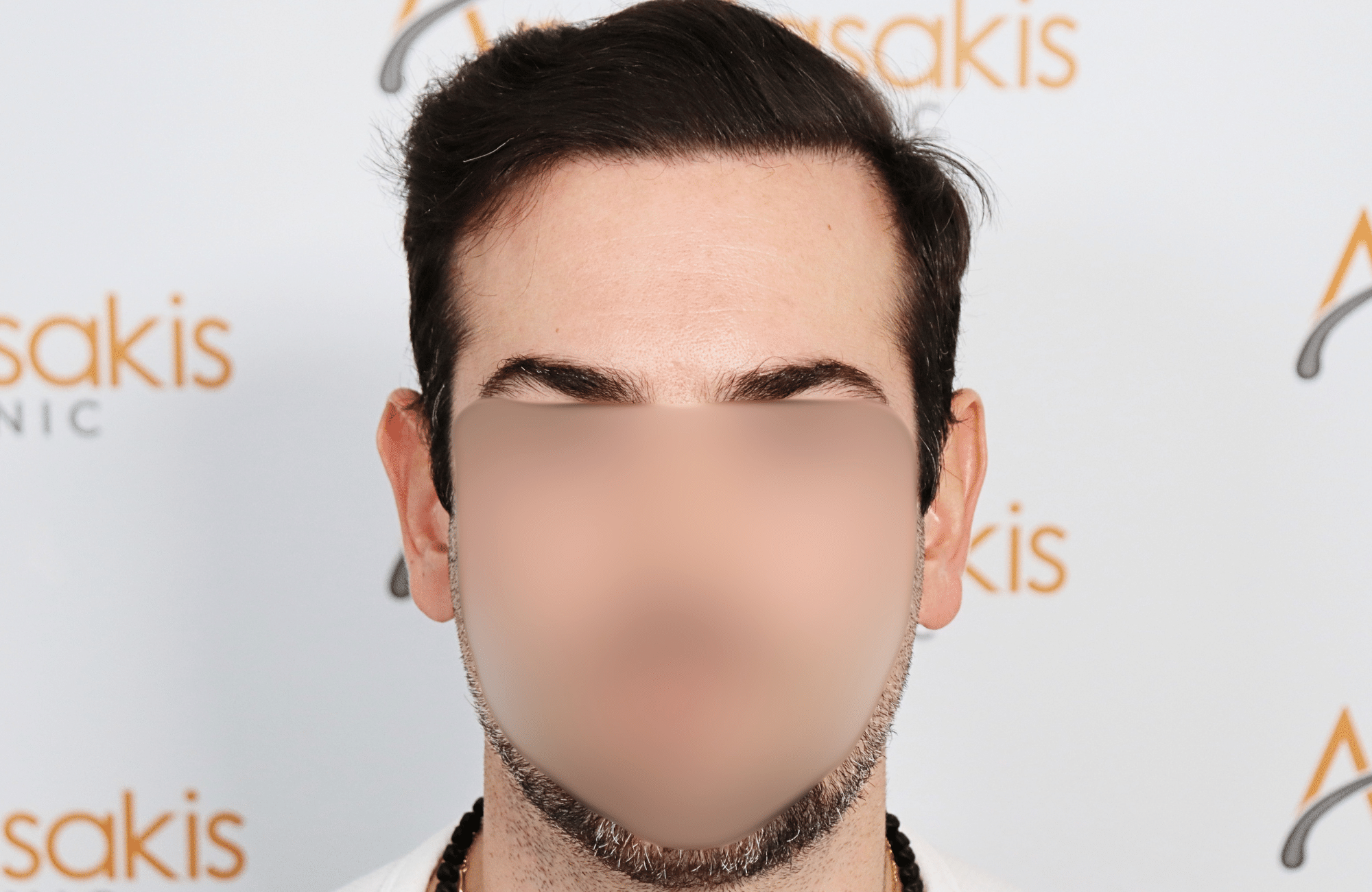 hair transplant result by dr konstantinos anastassakis with 2300 fus fullface after