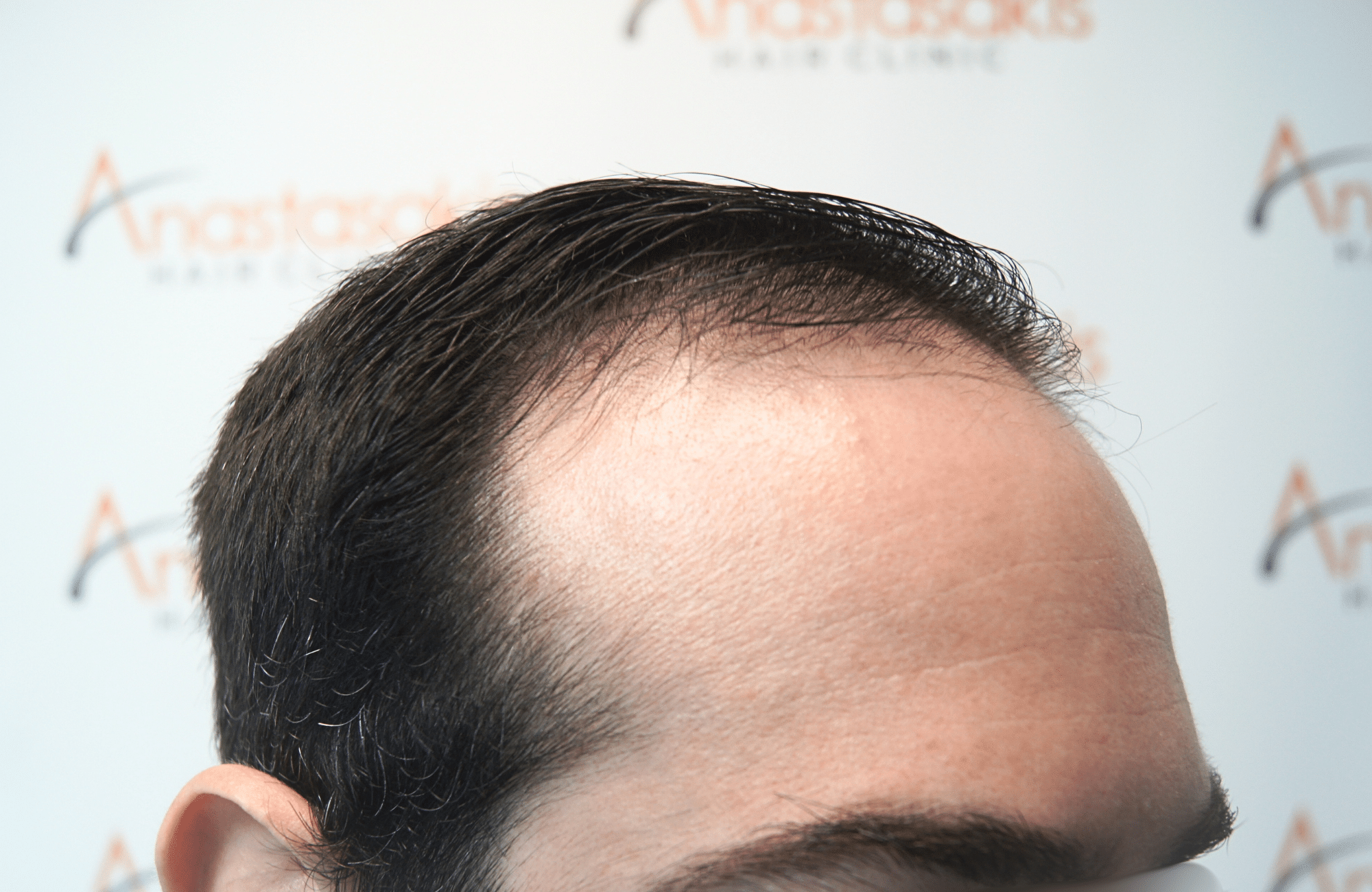 hair transplant result by dr konstantinos anastassakis with 2300 fus side1 before