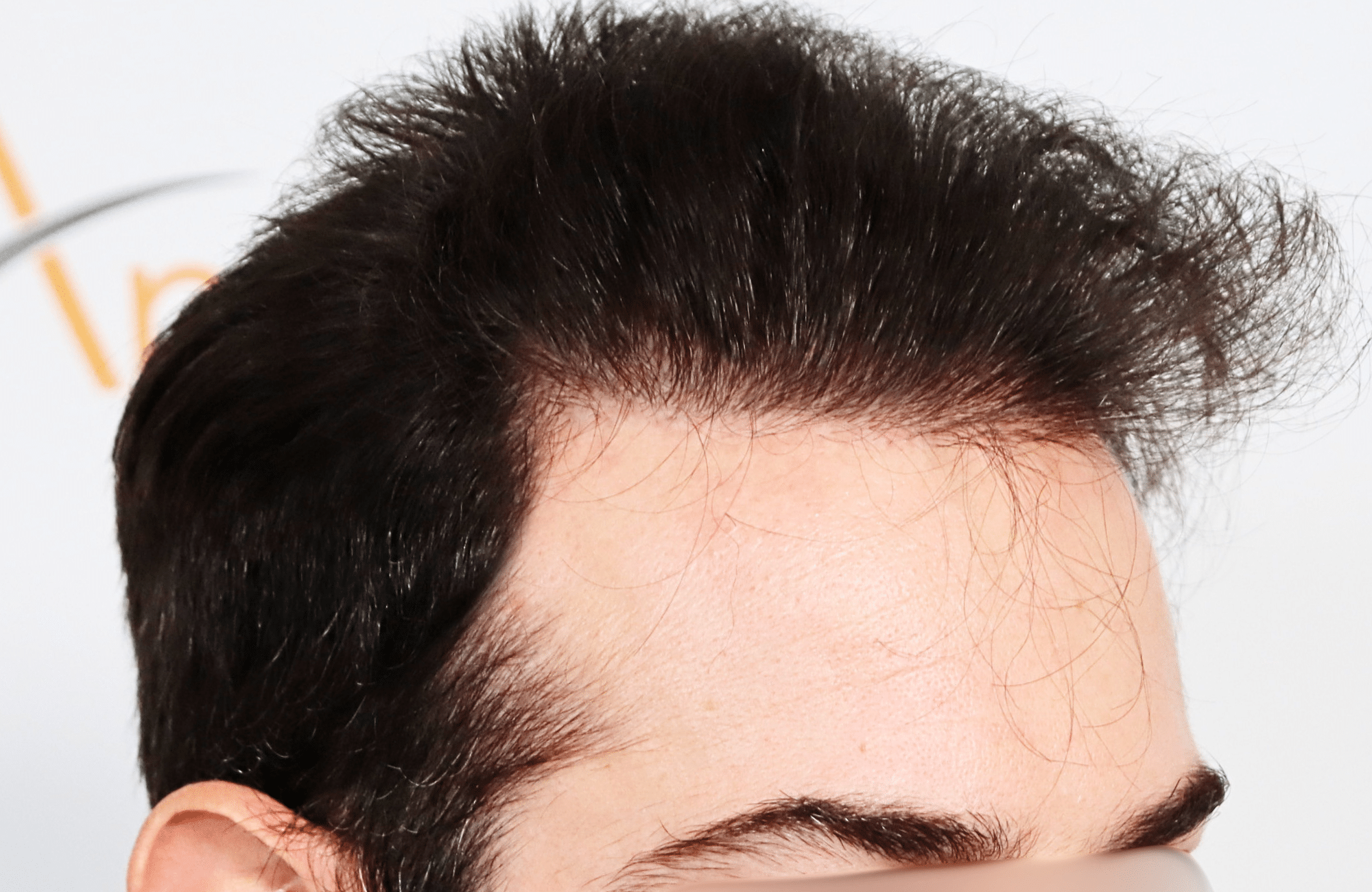 hair transplant result by dr konstantinos anastassakis with 2300 fus side1 after