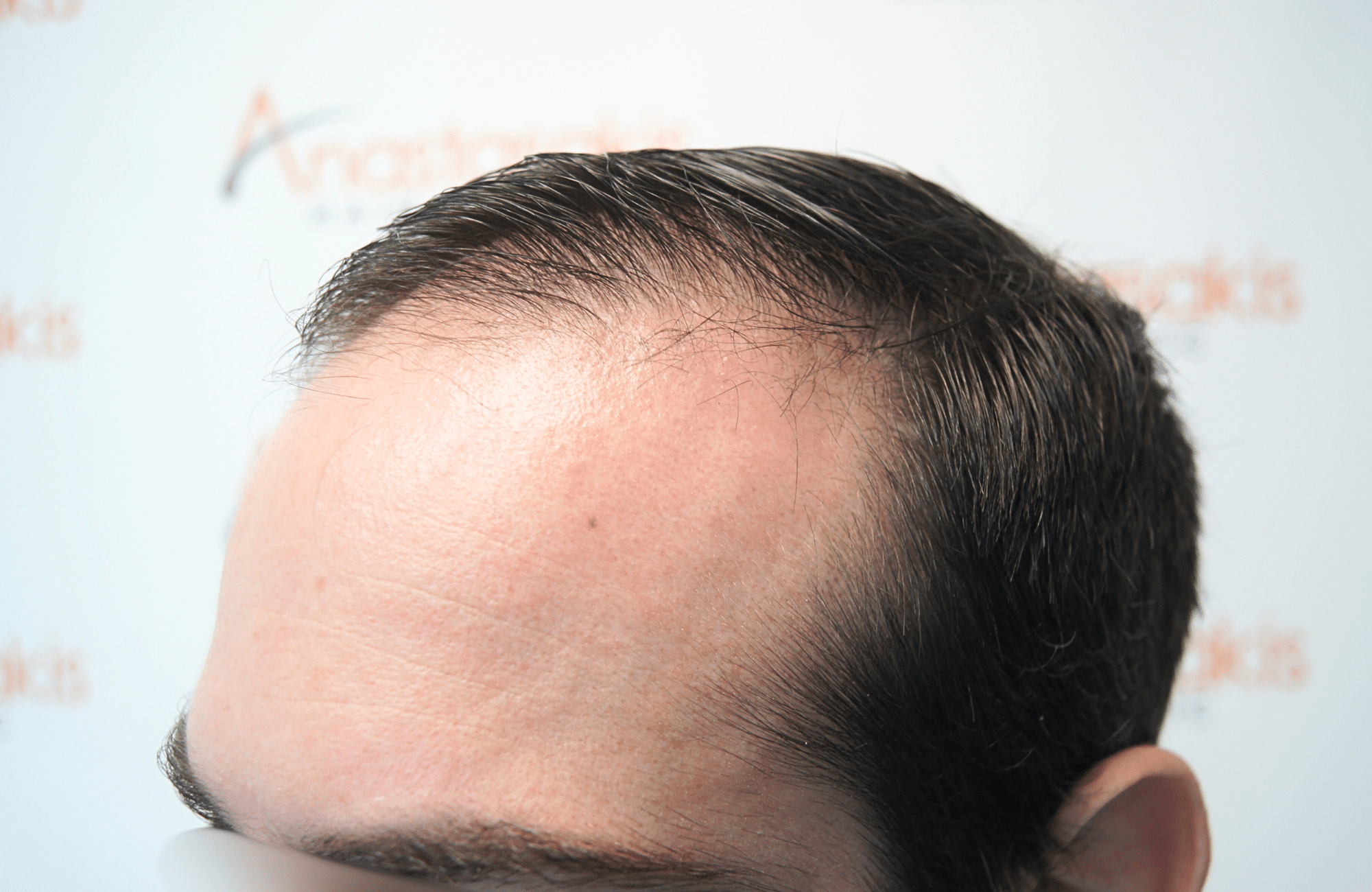 hair transplant result by dr konstantinos anastassakis with 2300 fus side2 before