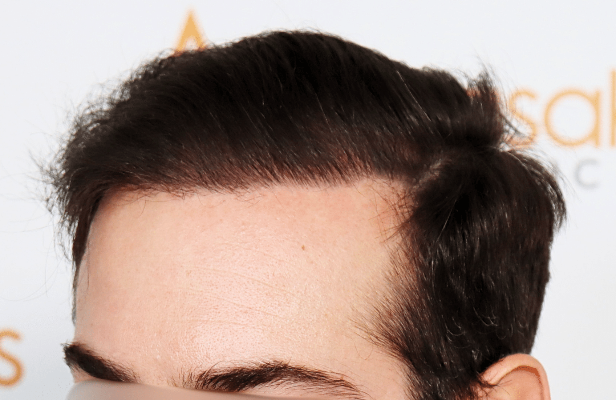 hair transplant result by dr konstantinos anastassakis with 2300 fus side2 after