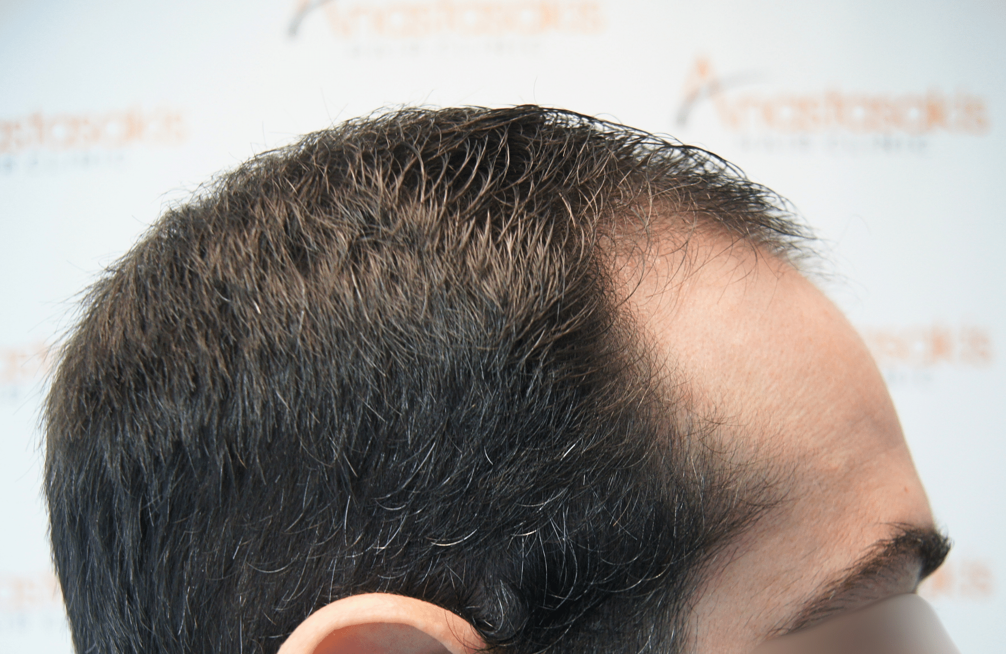 hair transplant result by dr konstantinos anastassakis with 2300 fus side3 before