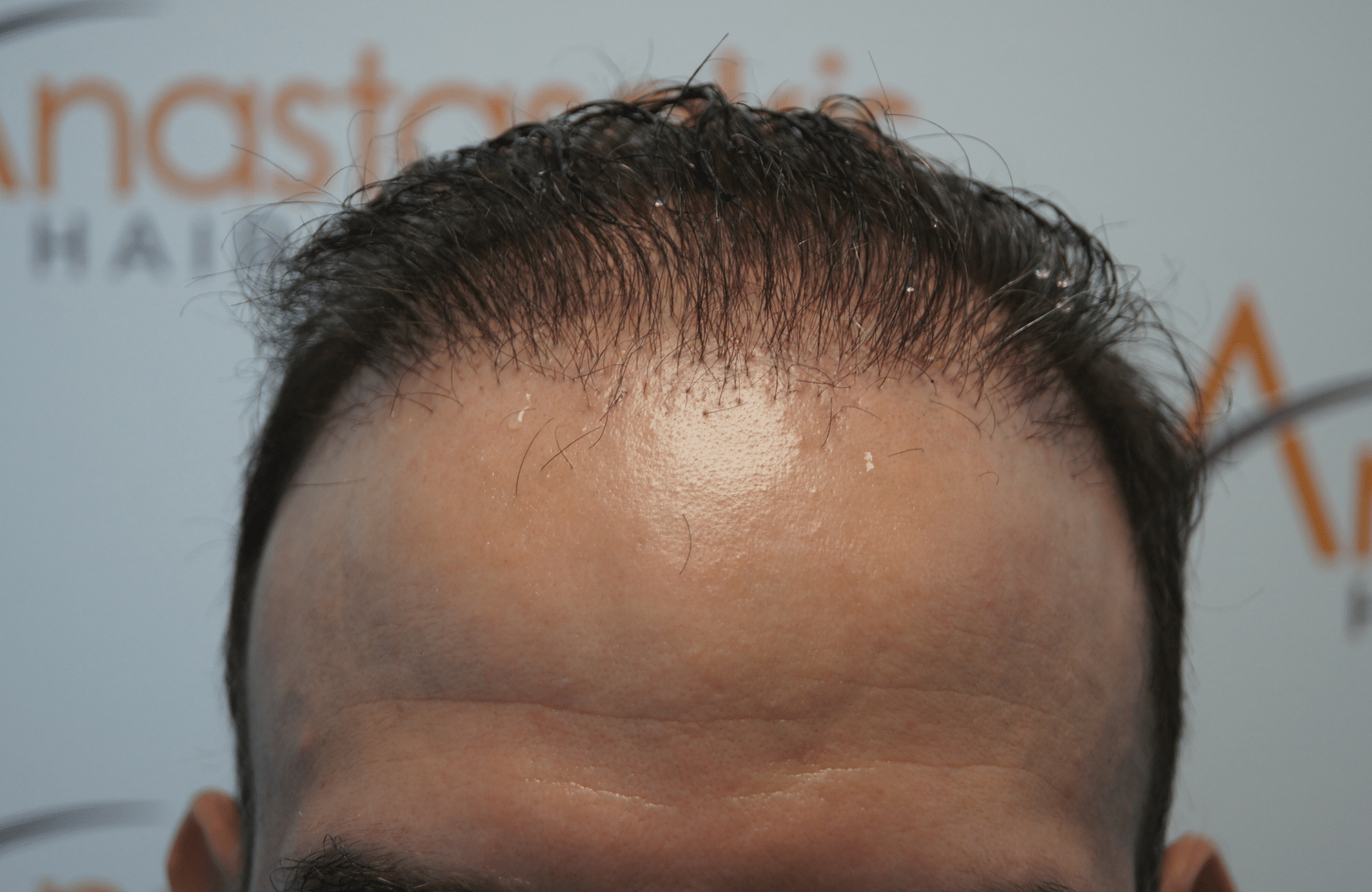 πριν τη μεταμοσχευση μαλλιων hairline