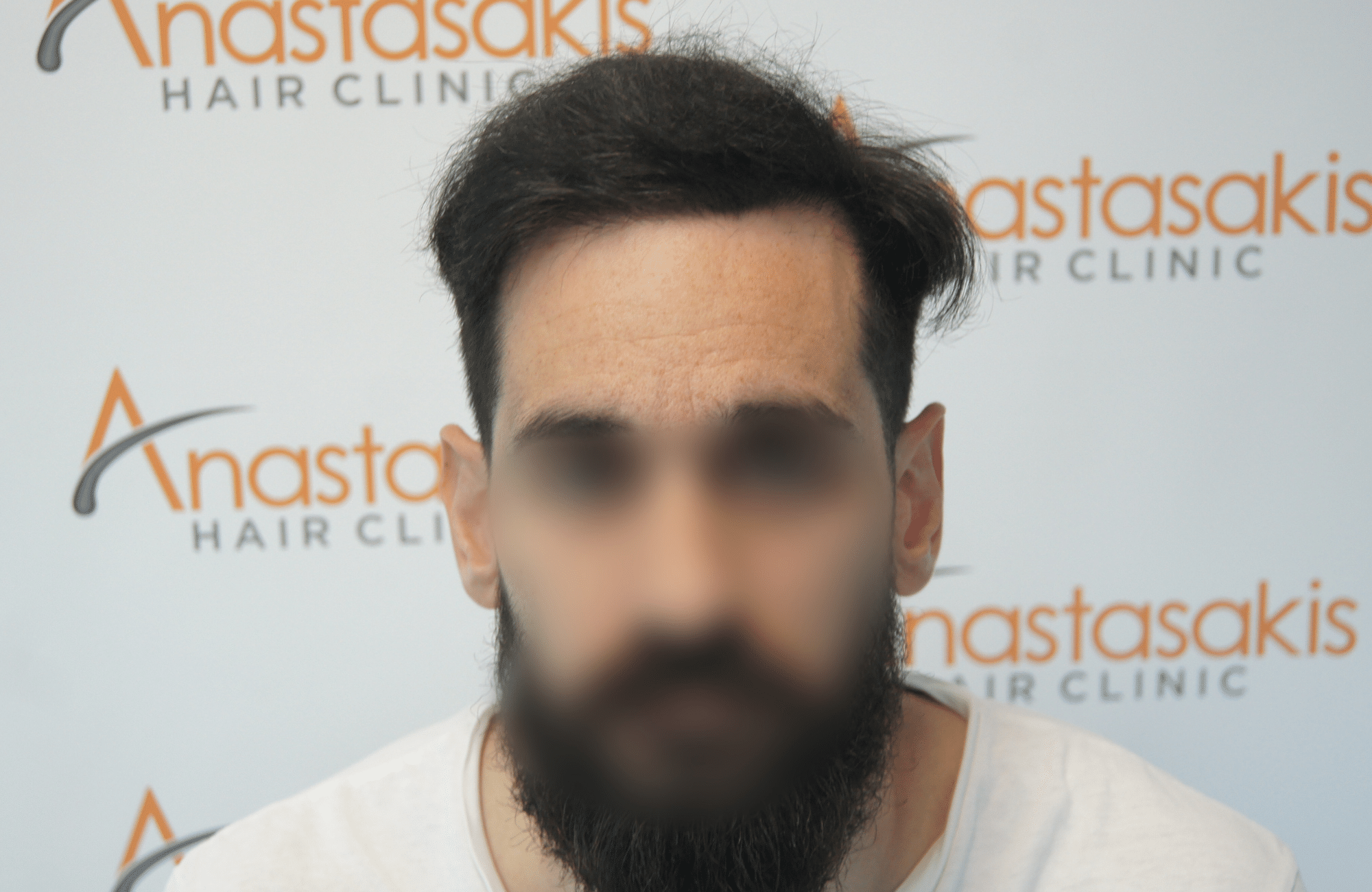μετα τη μεταμοσχευση μαλλιων 2100 τριχοθυλακιων fullface