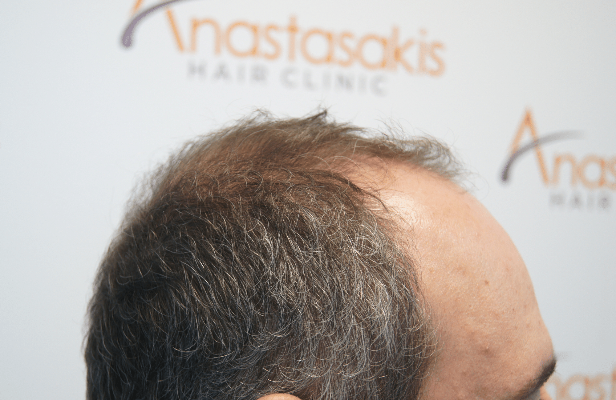 πριν τη μεταμοσχευση μαλλιων 2200 τριχοθυλακιων side4