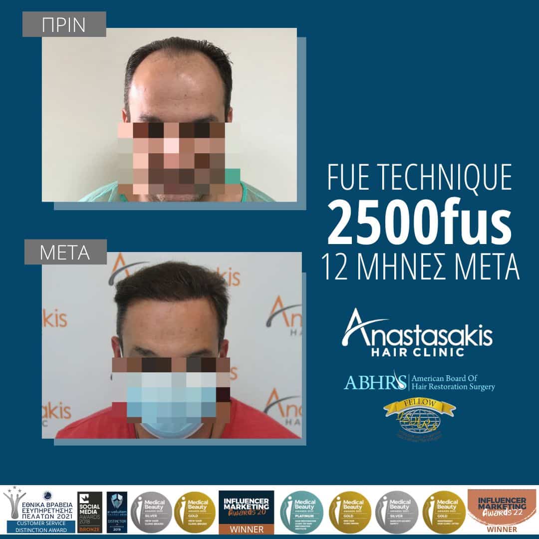 Οι μύθοι για τη μεταμόσχευση μαλλιών-πριν και μετά