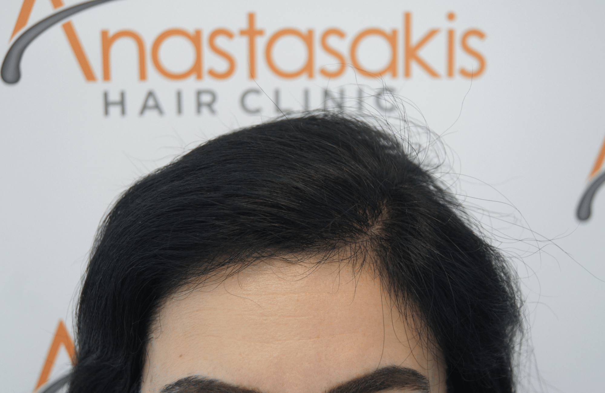 woman after hair transplant with 2200 fus combo - hairline