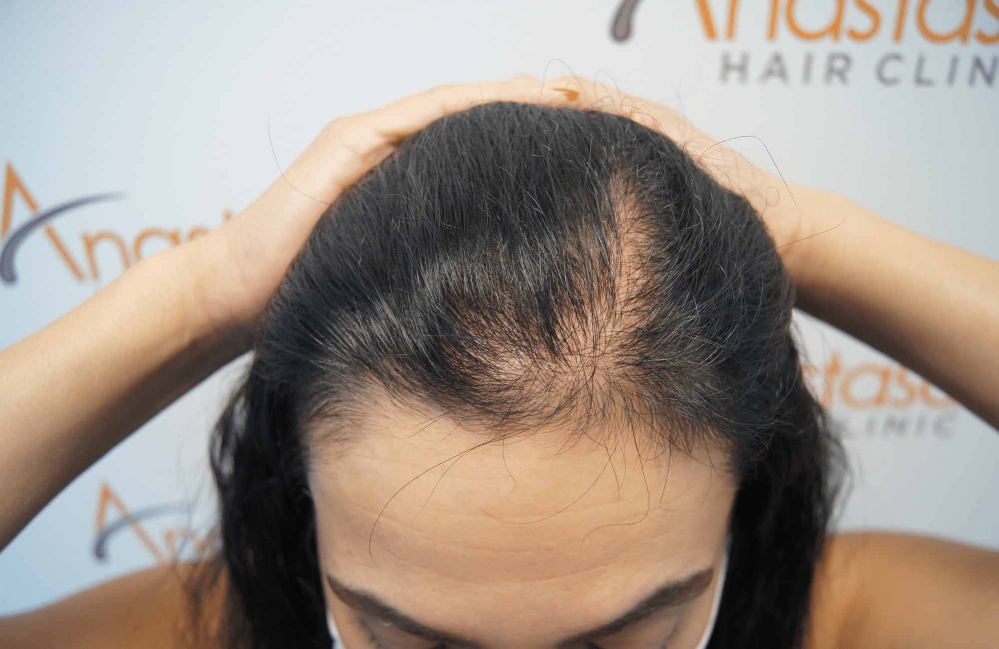 woman before hair transplant - up1