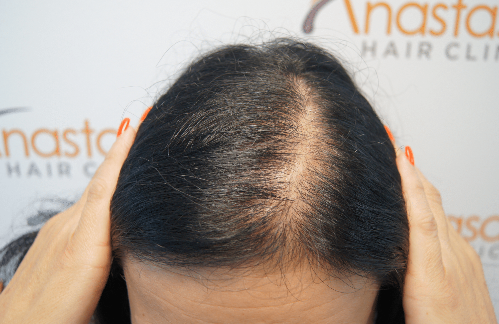woman before hair transplant - up2