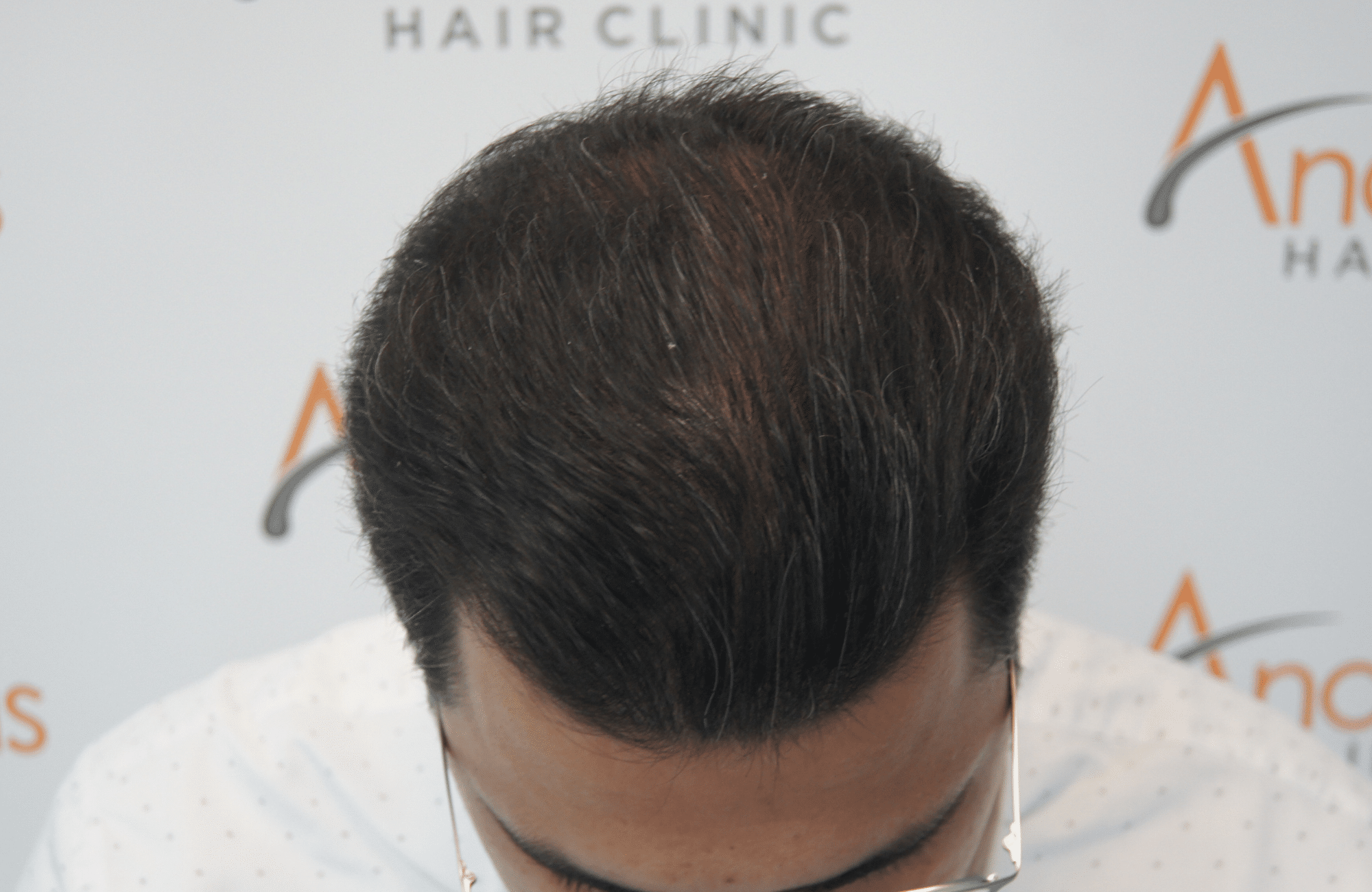 after hair transplant with 3500 fus up