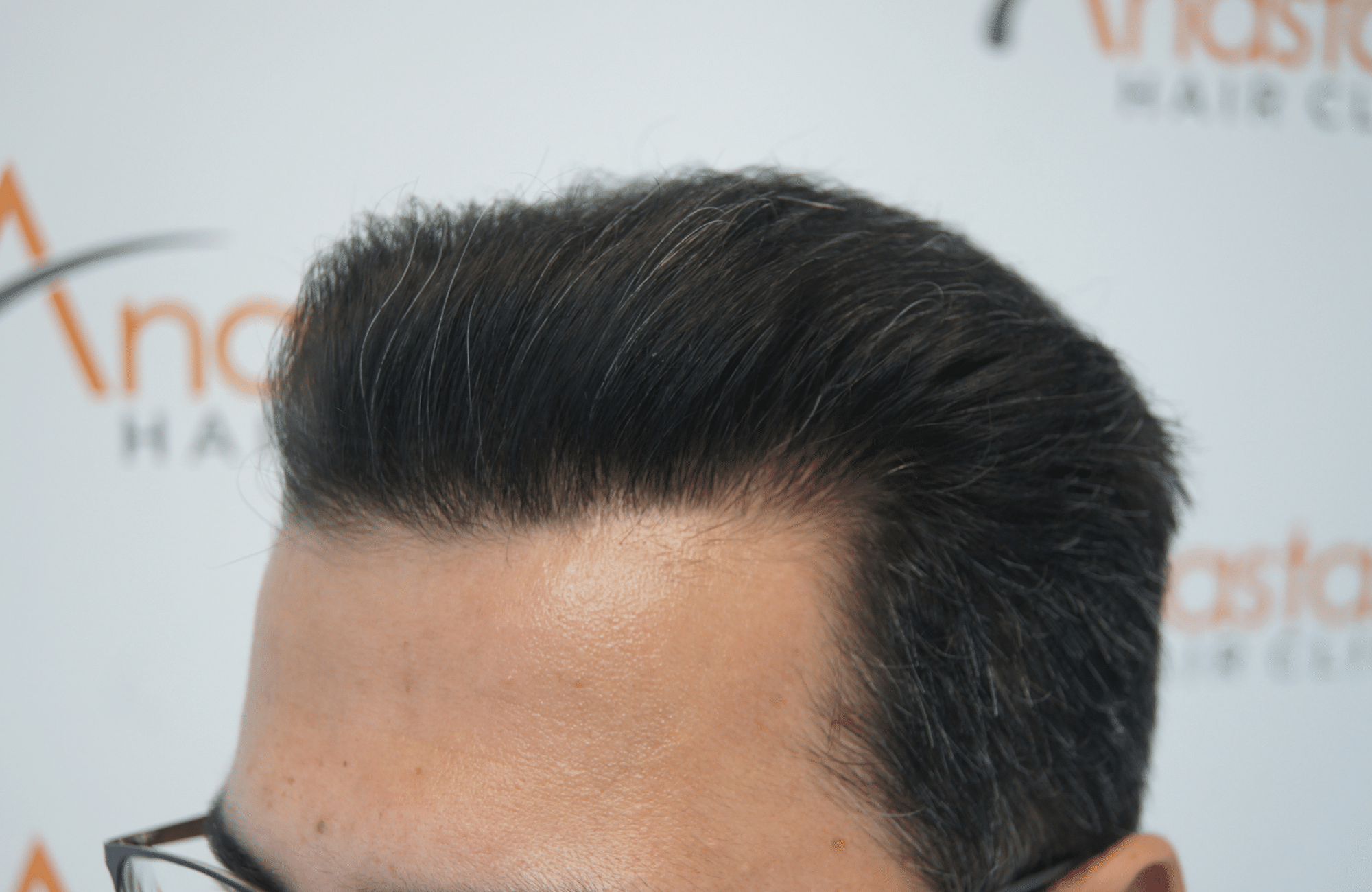 after hair transplant with 3500 fus side1