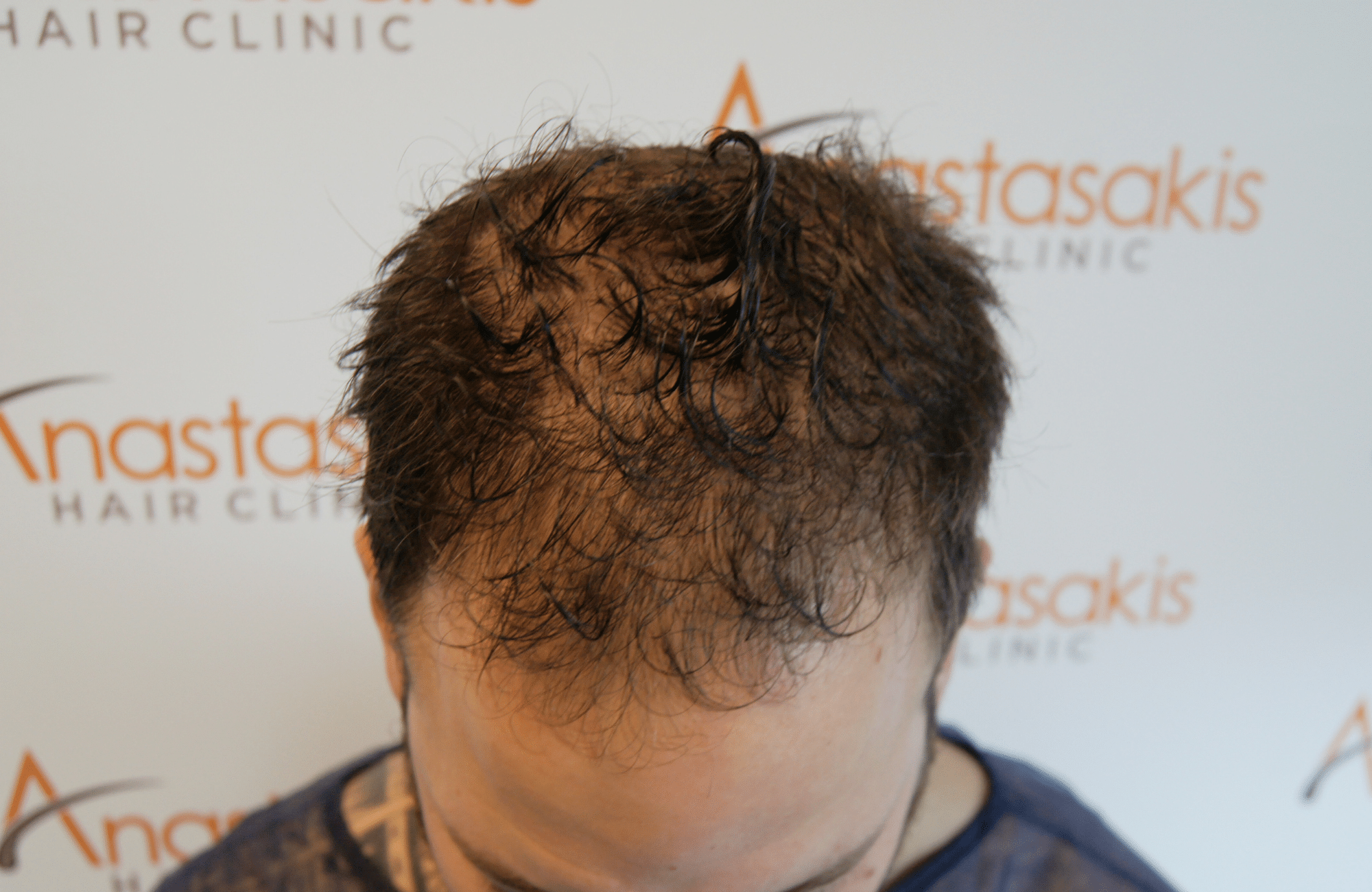 before hair transplant surgery with 2200 fus fue - up