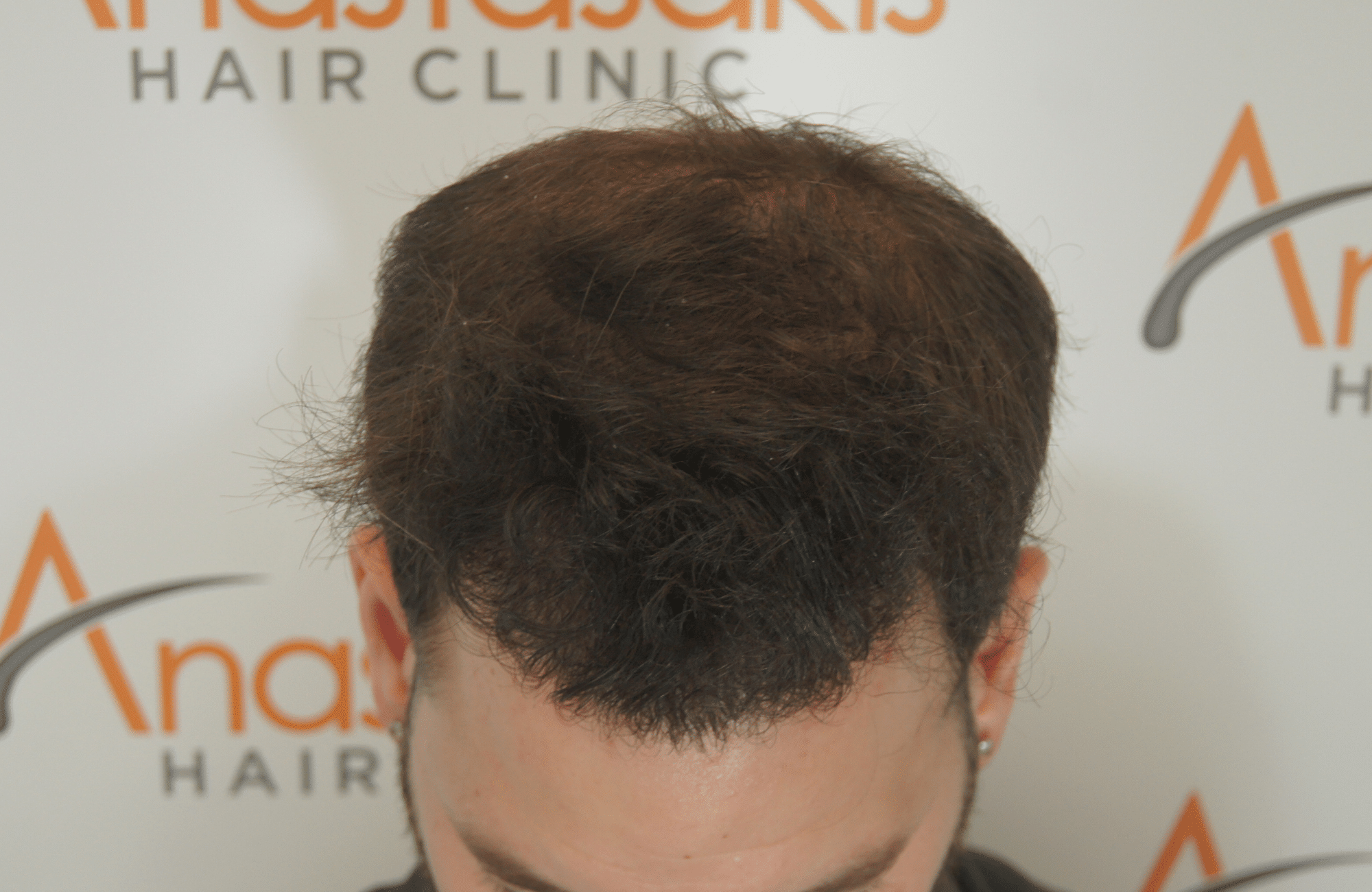 after hair transplant surgery with 2200 fus fue - up