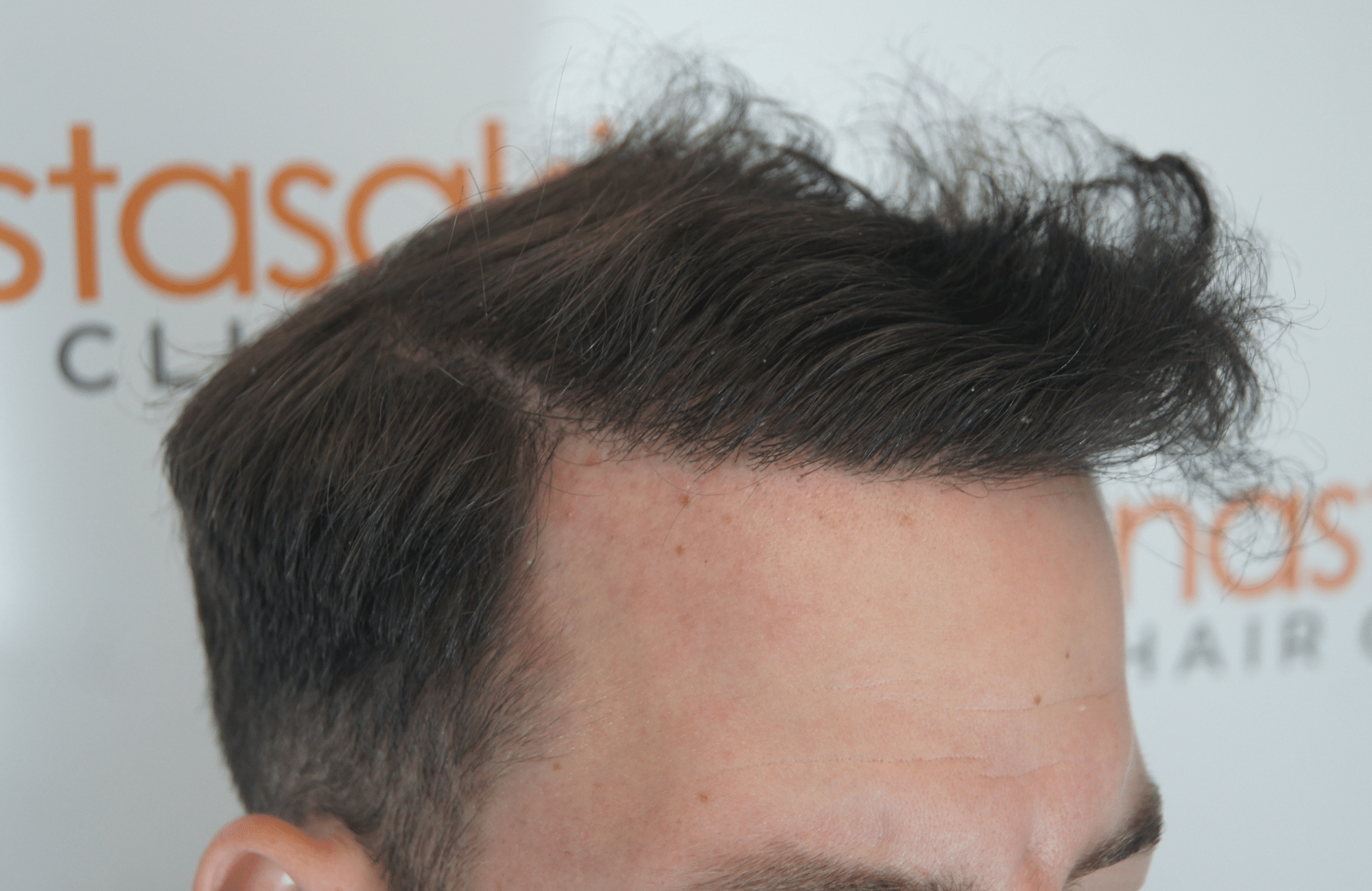 after hair transplant surgery with 2200 fus fue - side1