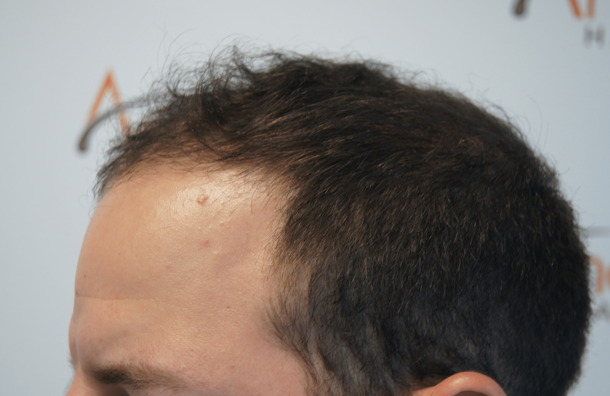 before hair transplant surgery with 2200 fus fue - side2