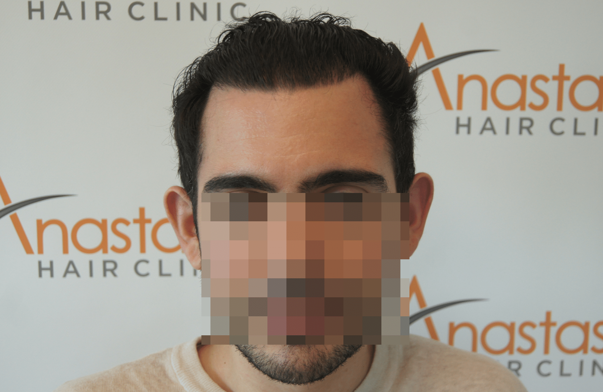 Αποτέλεσμα 9 μηνών μετά τη μεταμόσχευση μαλλιών.