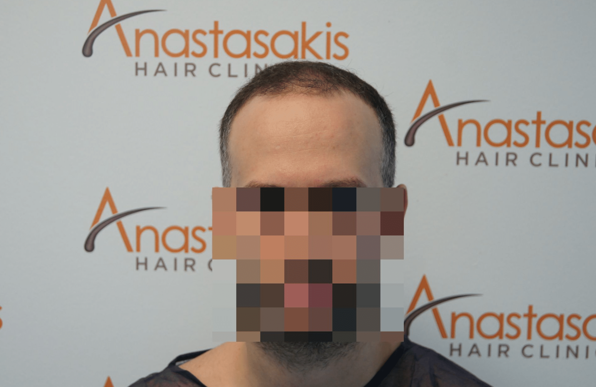περιστατικο πριν τη μεταμοσχευση μαλλιων με fue 3000 grafts - fullface