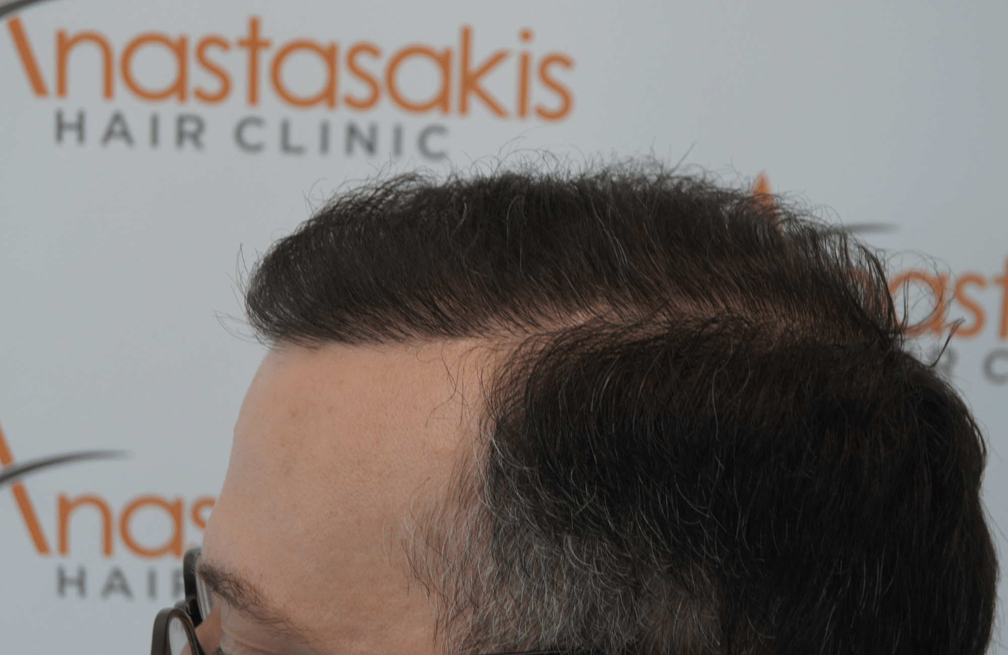περιστατικο μετα τη μεταμοσχευση μαλλιων με fue 3000 grafts - side1