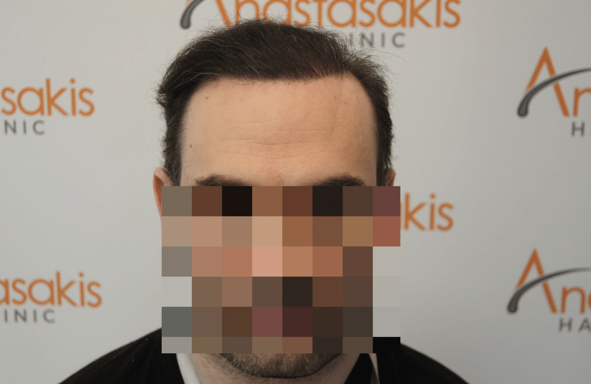 peristatiko repair meta ti metamosxefsi mallion me 2500 fus fullface