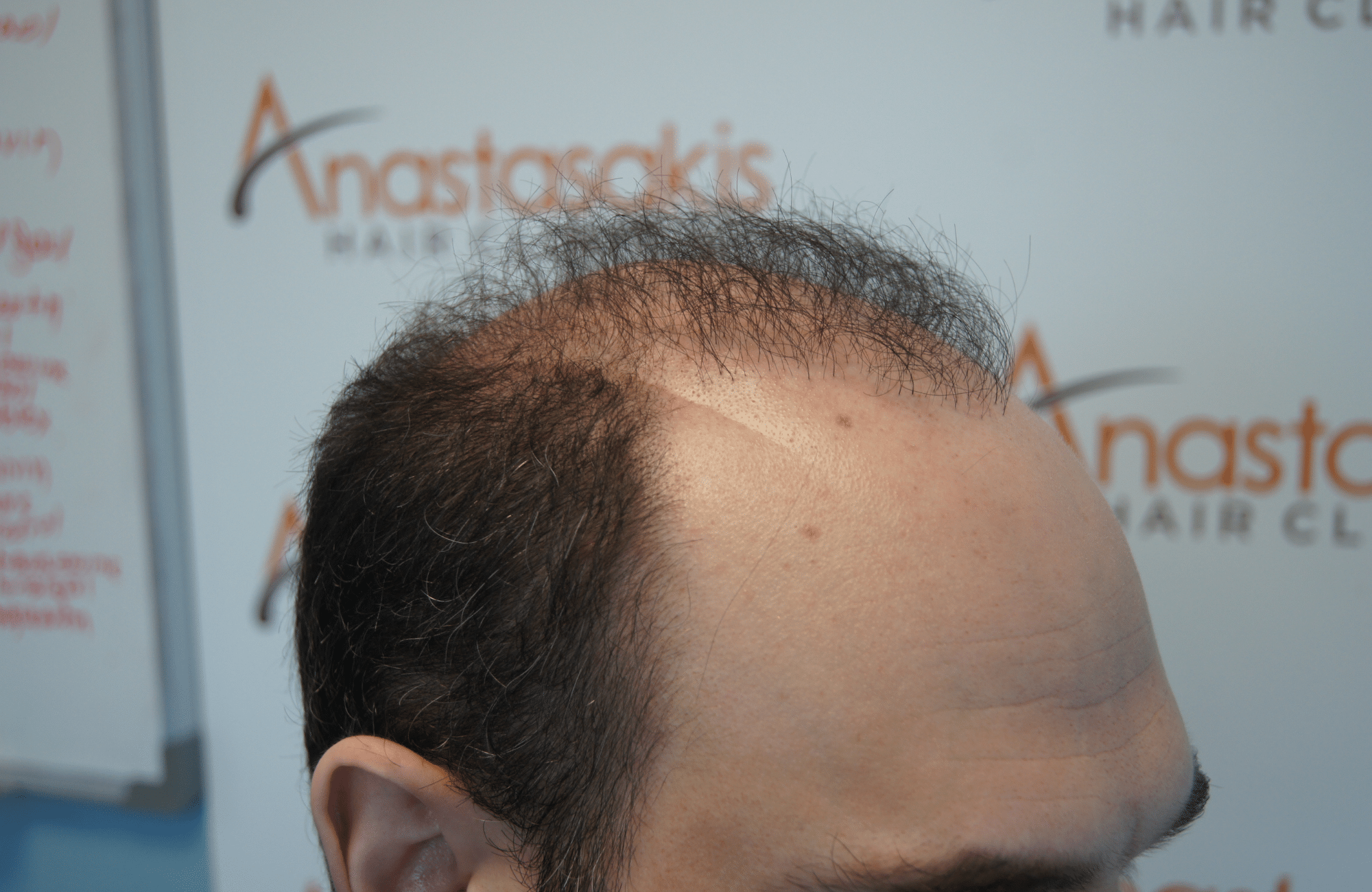 peristatiko repair prin ti metamosxefsi mallion me 2500 fus side1