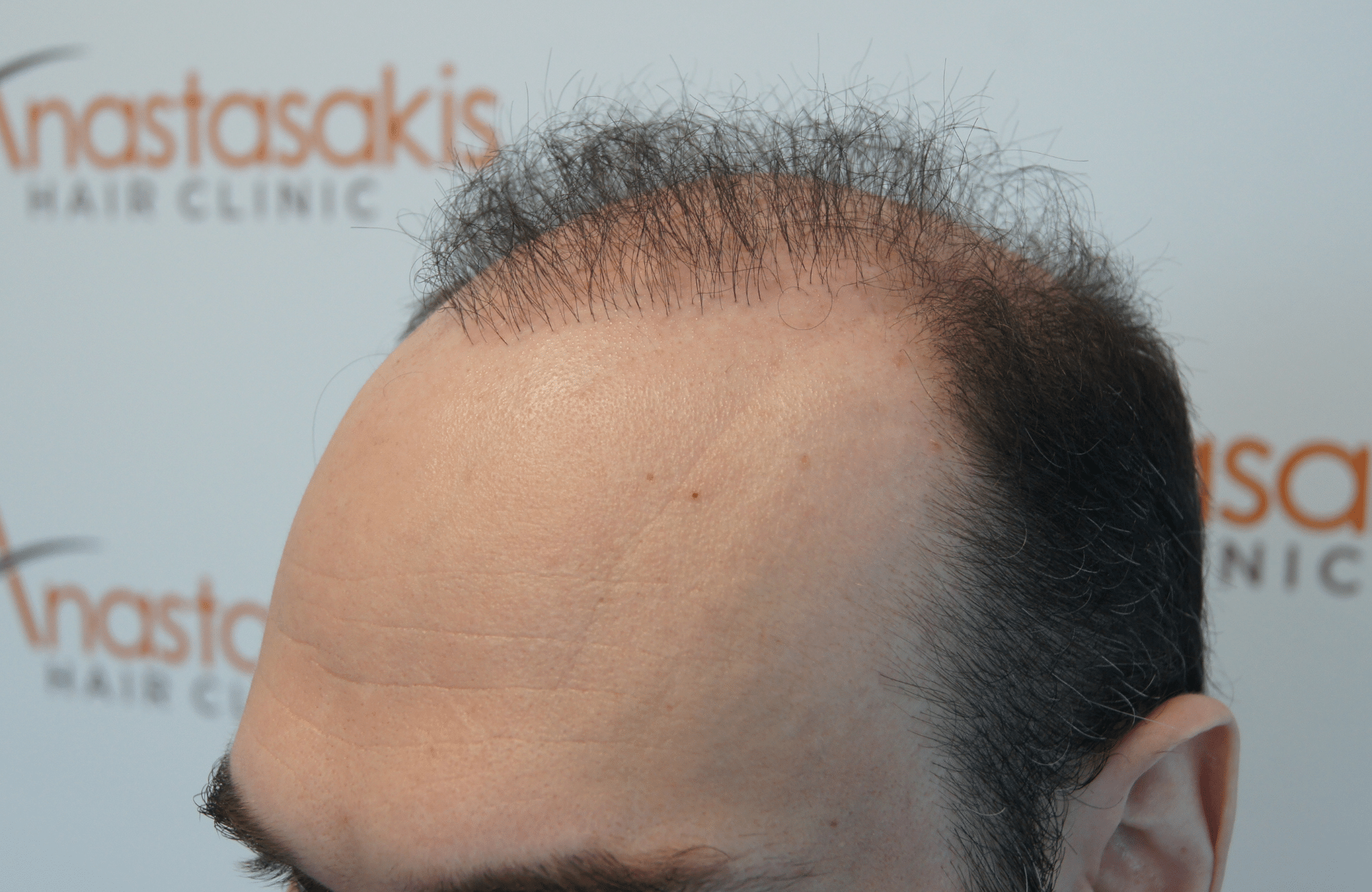 peristatiko repair prin ti metamosxefsi mallion me 2500 fus side2