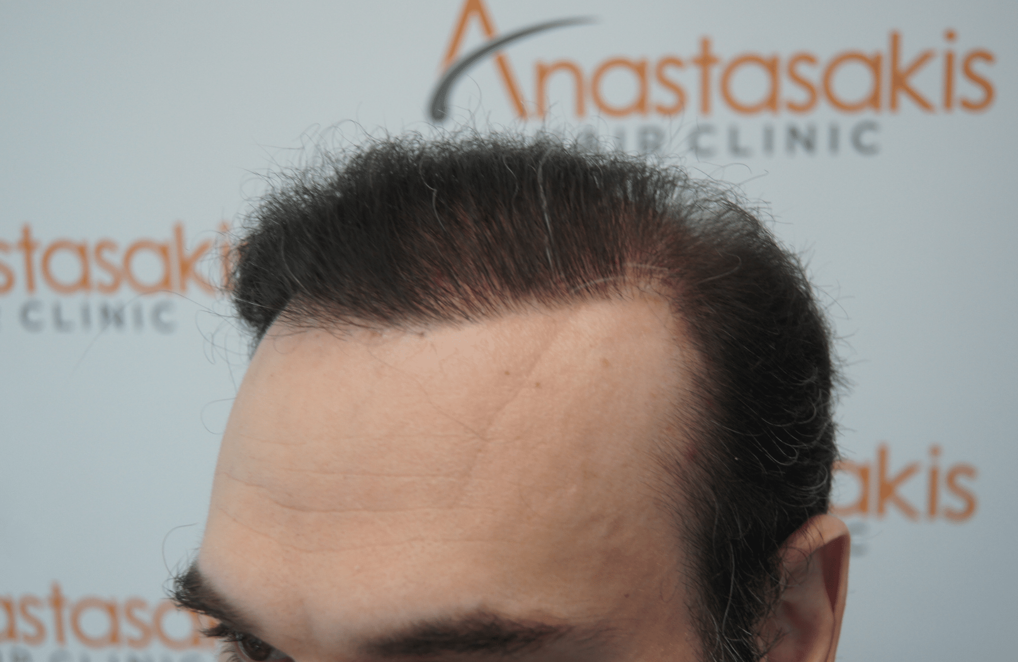 peristatiko repair meta ti metamosxefsi mallion me 2500 fus side2