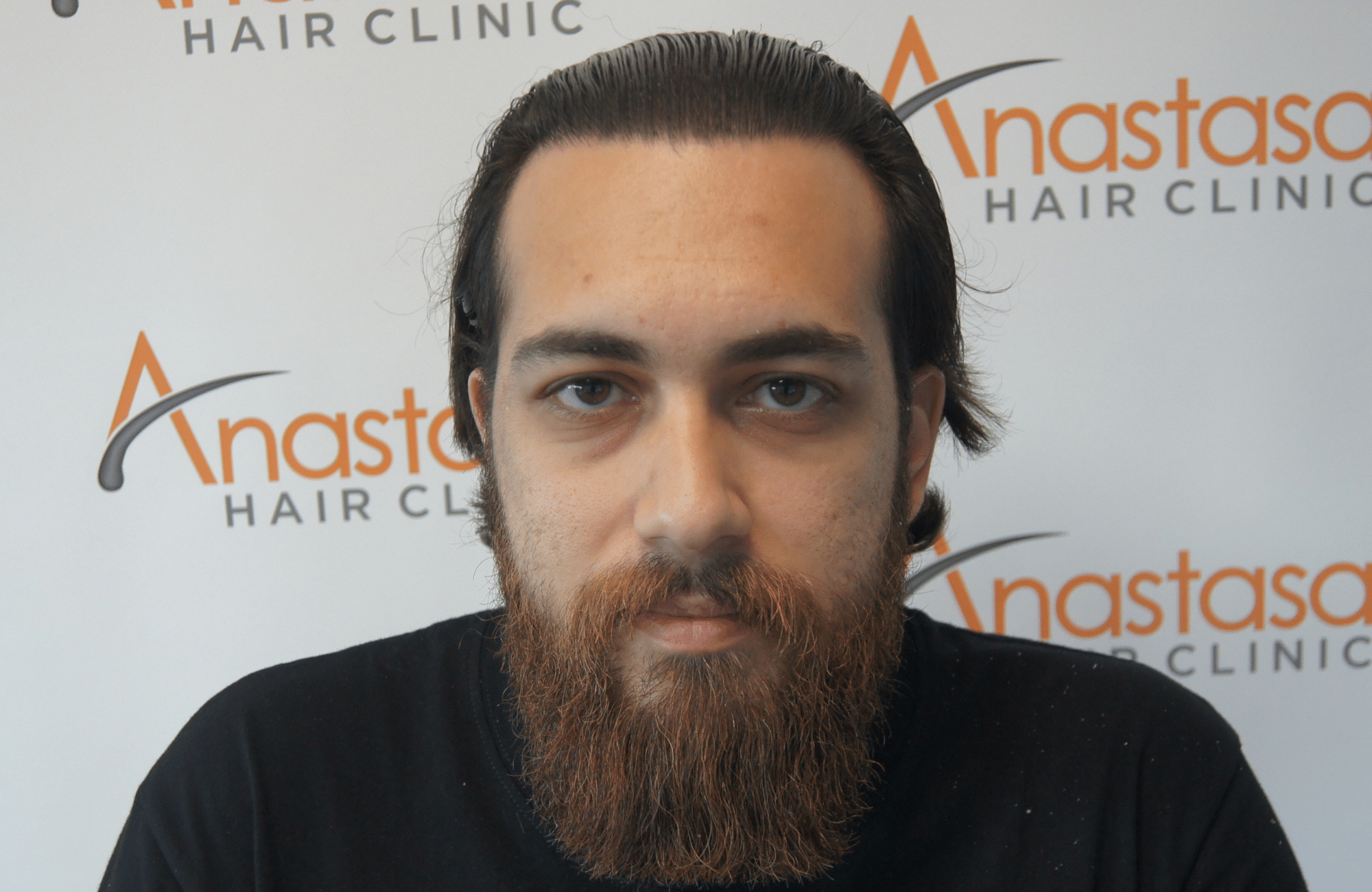 απολυτα φυσικό αποτελεσμα στη μεταμόσχευση μαλλιων στην anastasakis hair clinic ΜΕ 2500 ΤΡΙΧΟΘΥΛΑΚΙΑ