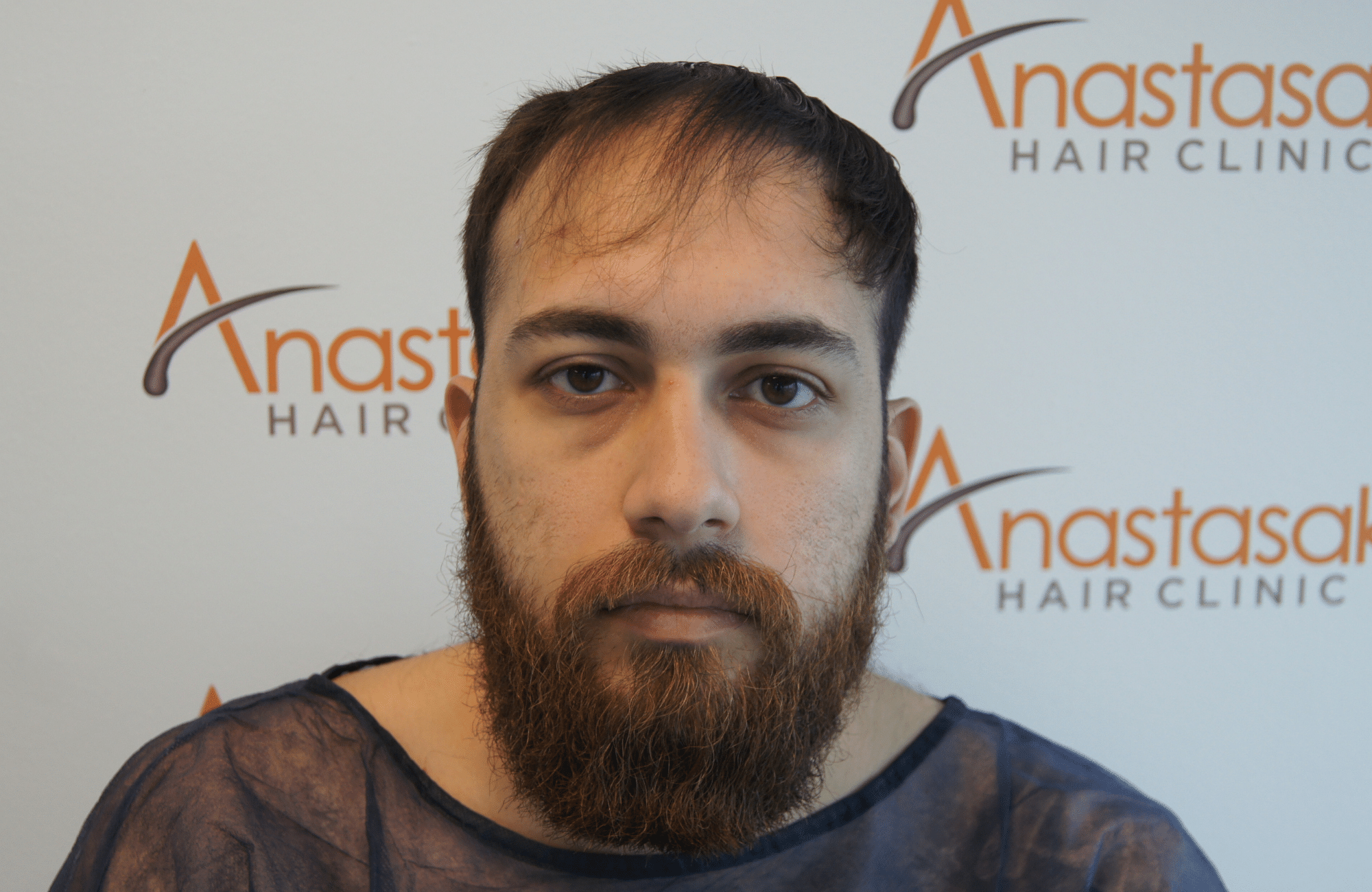 απολυτα φυσικό αποτελεσμα στη μεταμόσχευση μαλλιων στην anastasakis hair clinic ΜΕ 2500 ΤΡΙΧΟΘΥΛΑΚΙΑ