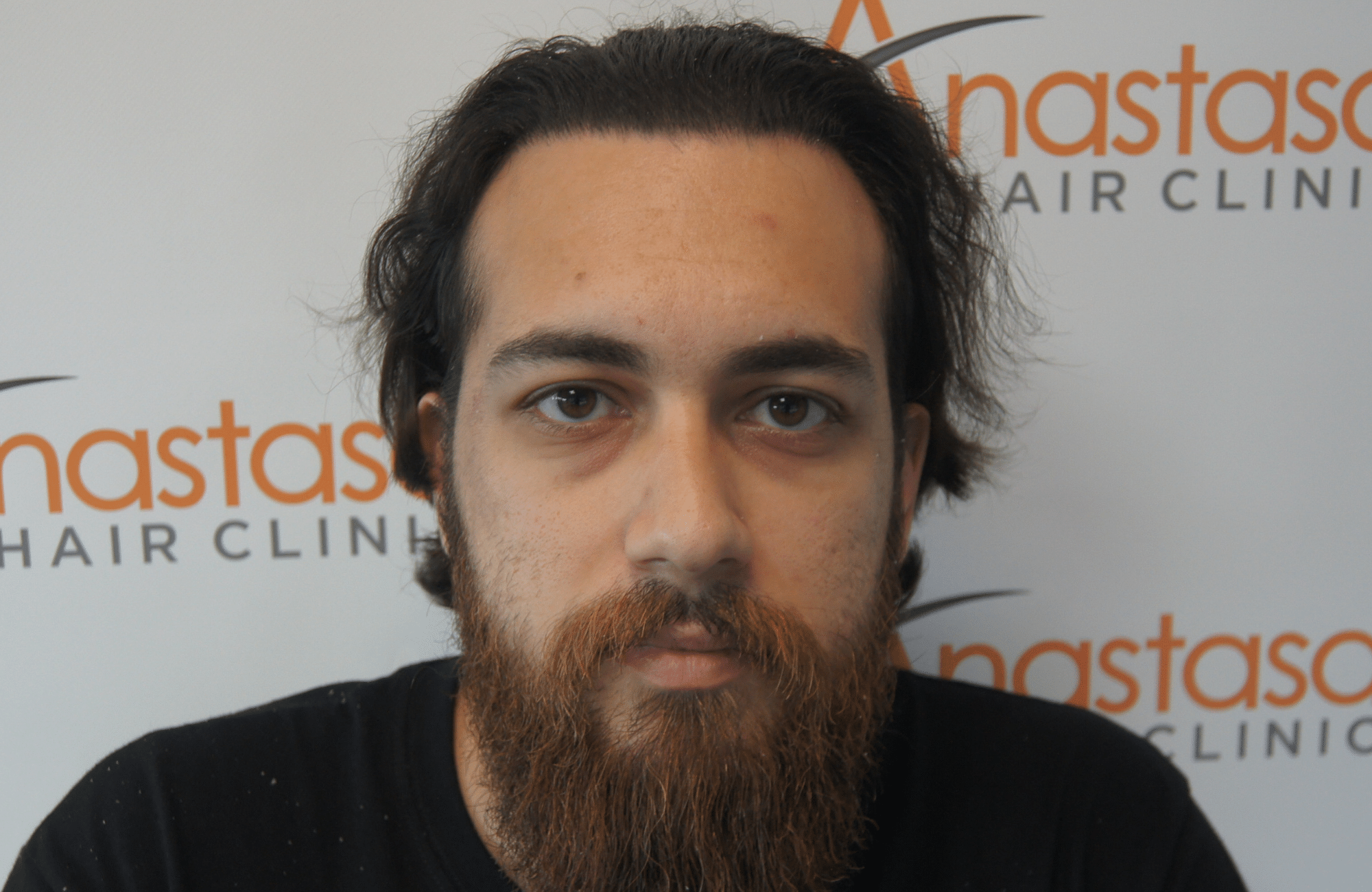 απολυτα φυσικό αποτελεσμα στη μεταμόσχευση μαλλιων στην anastasakis hair clinic ΜΕ 2500 ΤΡΙΧΟΘΥΛΑΚΙΑ
