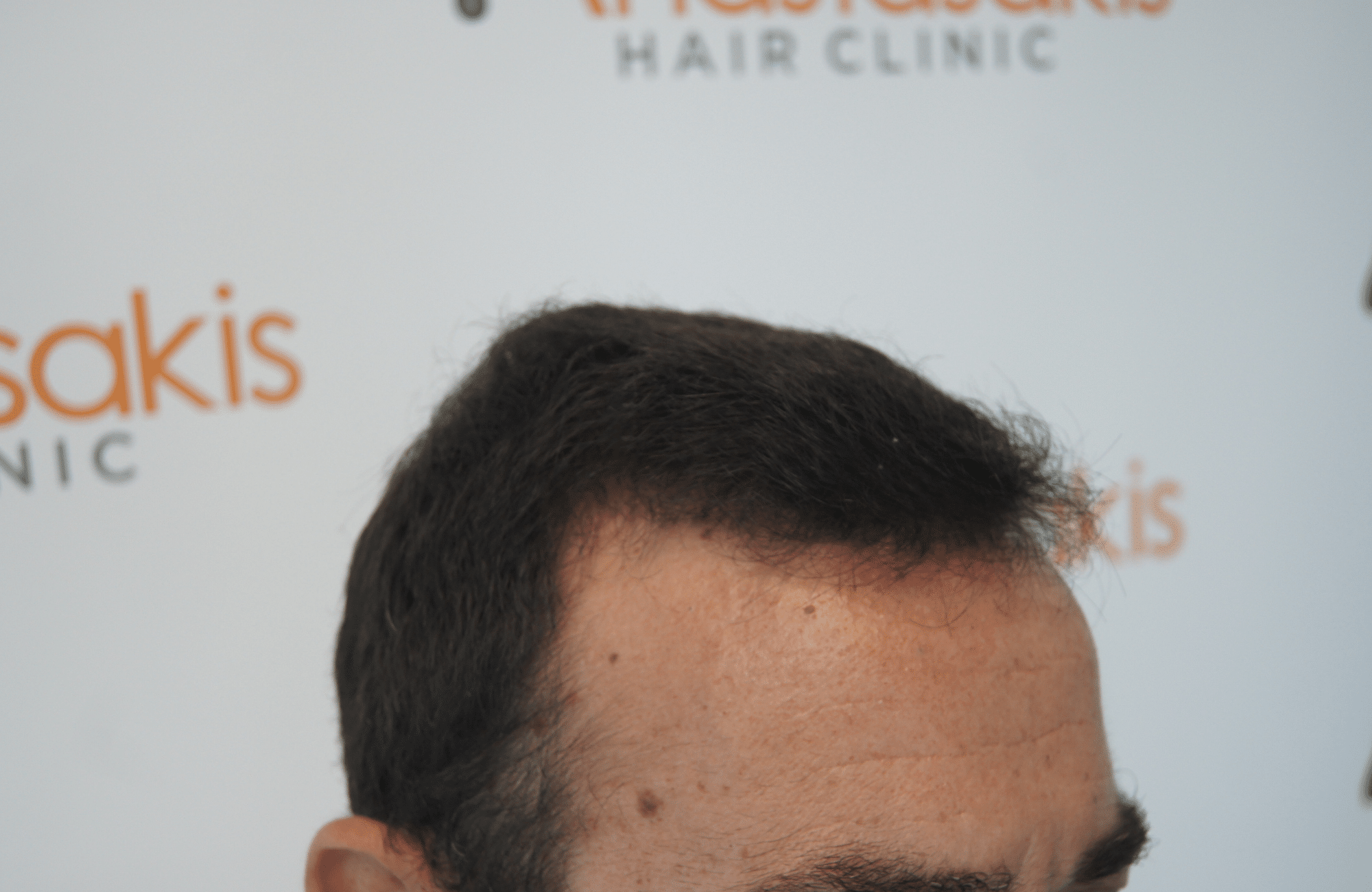 hair transplant result with 1700fus fue method - side1