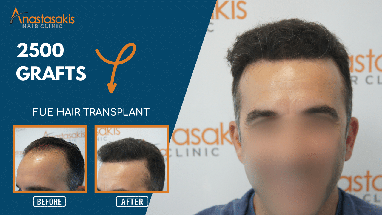 hairline φουλ μαλλια με 2500 grafts