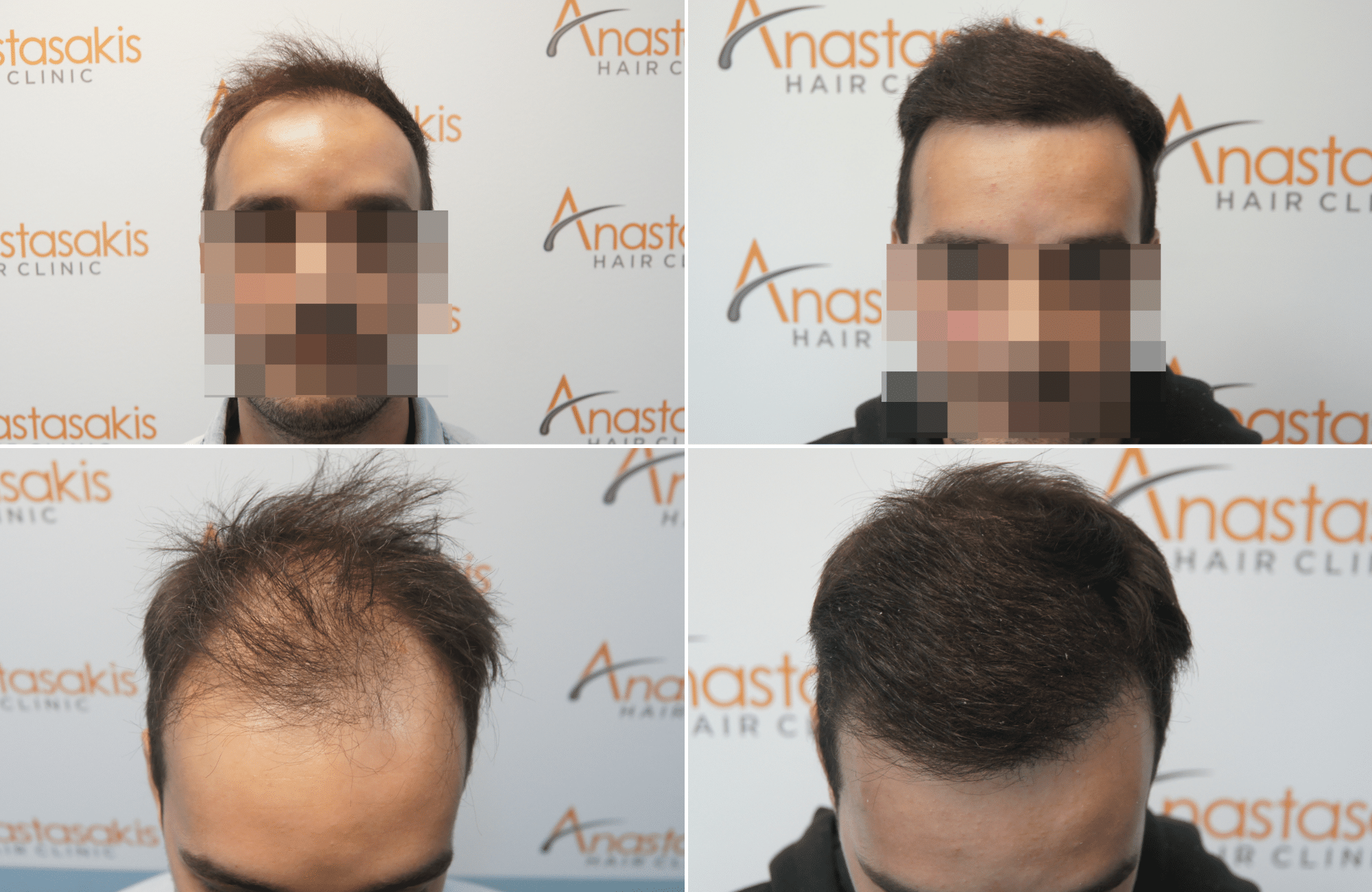https://anastasakishairclinic.com/portfolio/hair-transplant-result-anastasakis-hair-clinic-376/