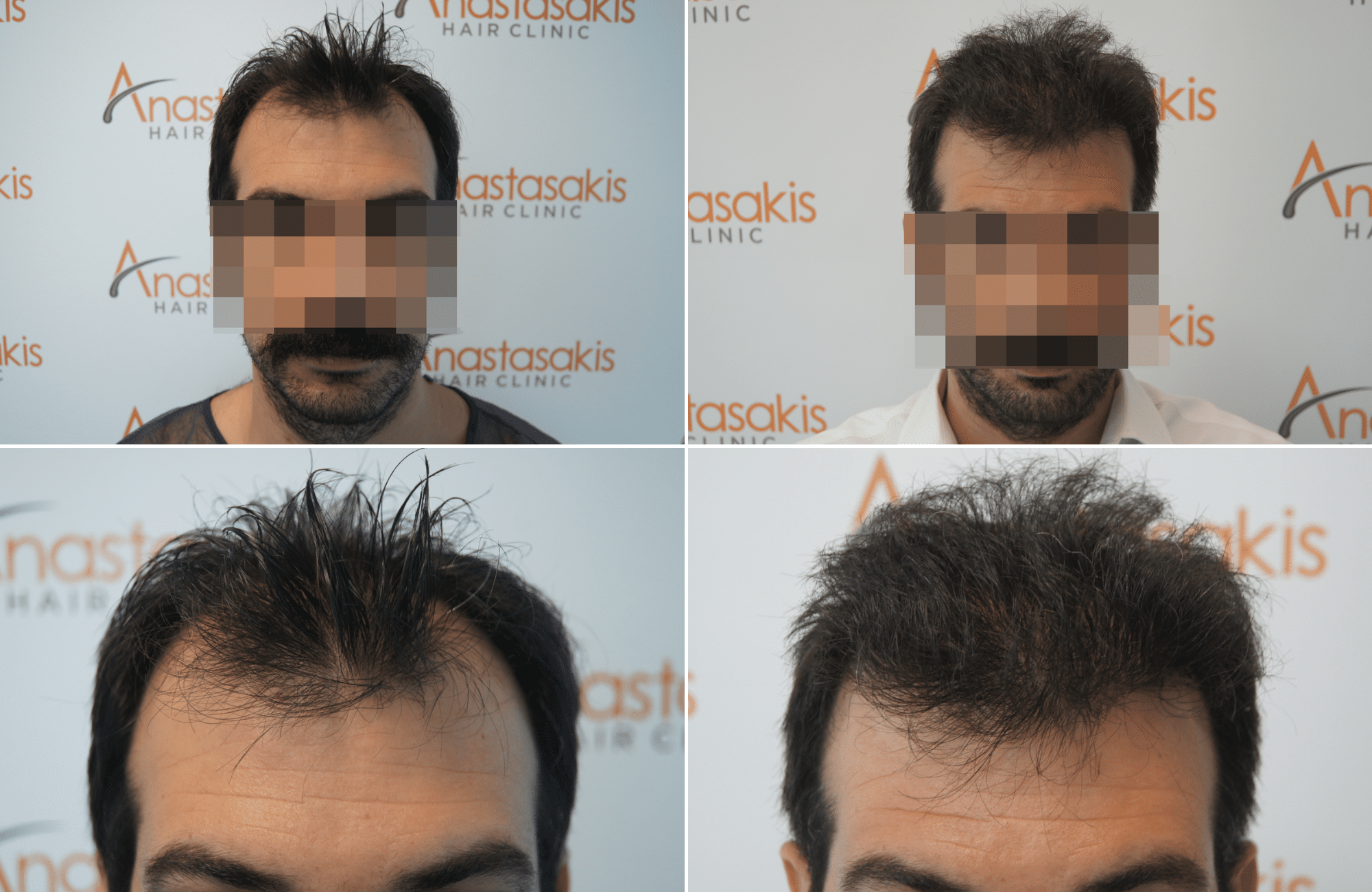 https://anastasakishairclinic.com/portfolio/hair-transplant-result-anastasakis-hair-clinic-377/