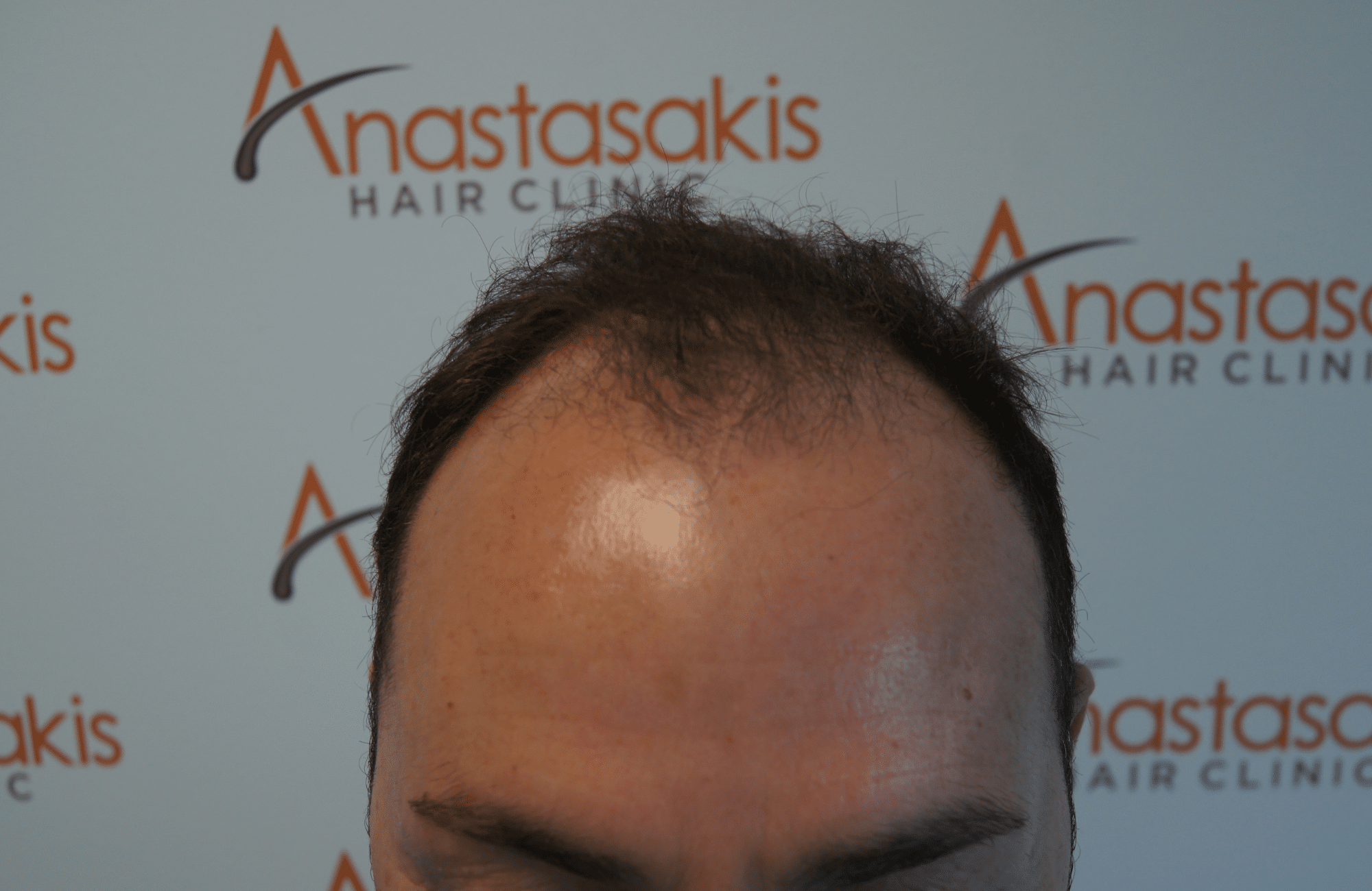 hair transplant patient result with 3500 fus before - hairline