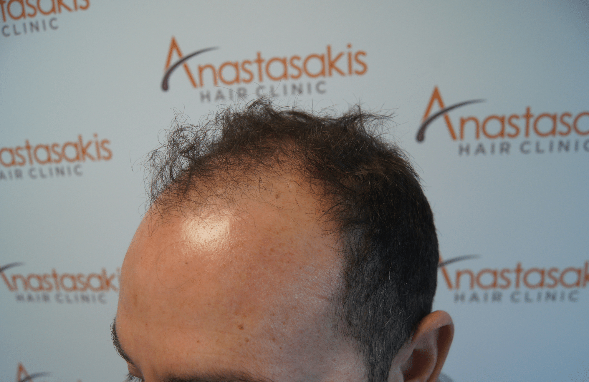 hair transplant patient result with 3500 fus before - side1